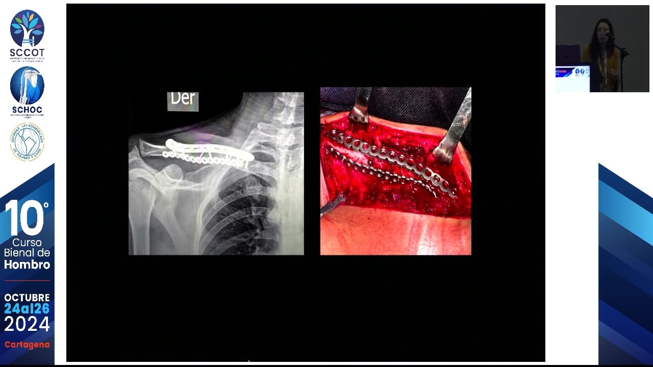 Doble placa en osteosíntesis primaria de clavícula - Beneficios