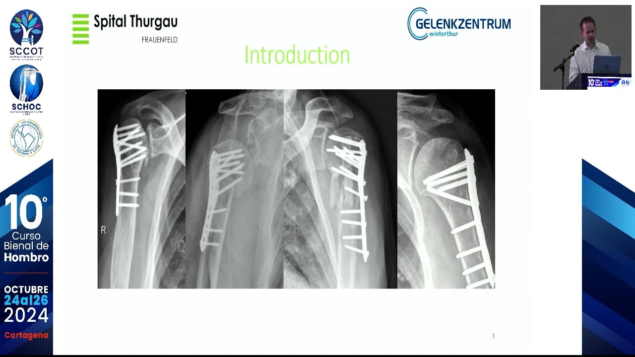 La malaunión de la tuberosidad mayor luego de RTH reverso