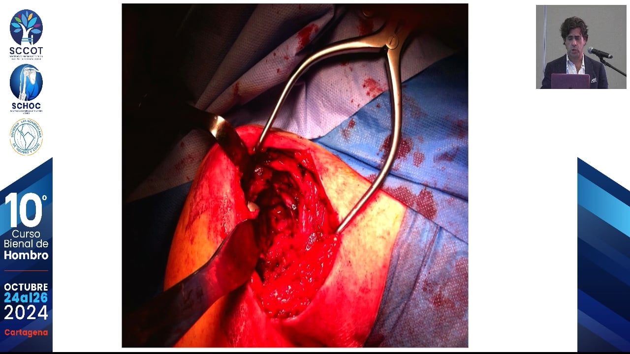 Complicaciones en prótesis anatómica aproximación terapéutica