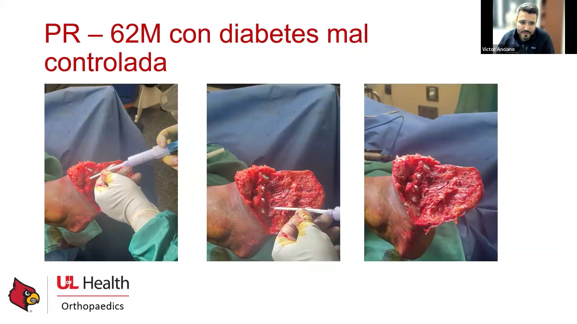 Webinar Manejo de las infecciones óseas en un solo paso