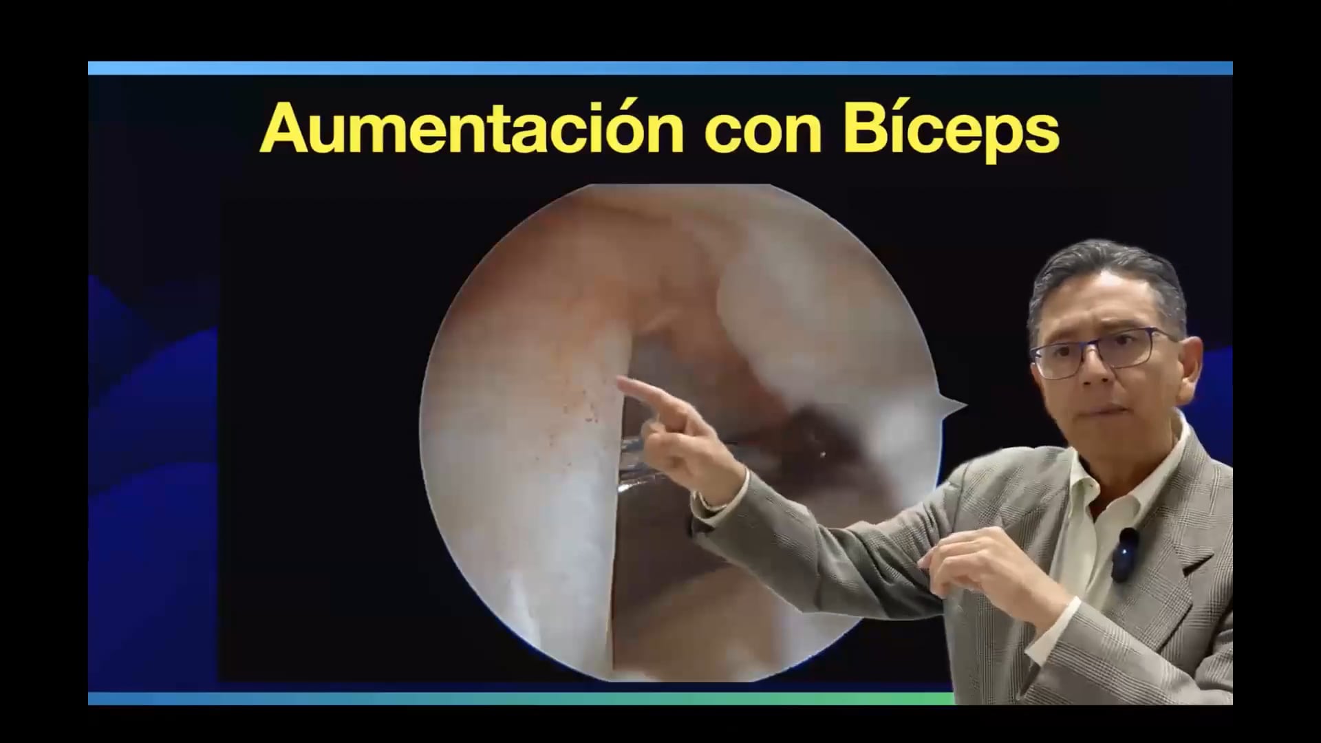 WEBINAR Ruptura masiva irreparable posterosuperior. Opciones diferentes a transferencia tendinosa