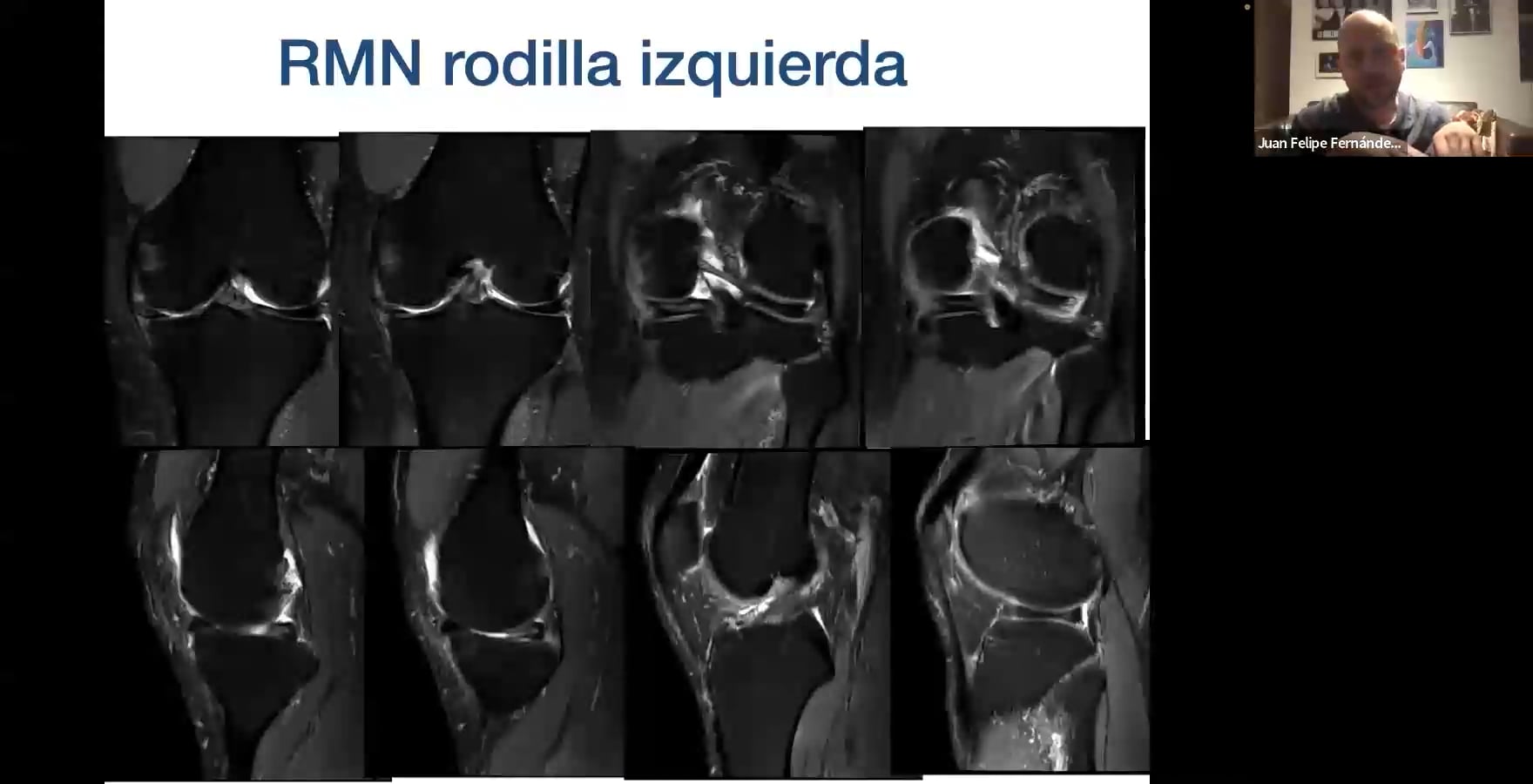 WEBINAR  Osteotomías periarticulares en RODILLA