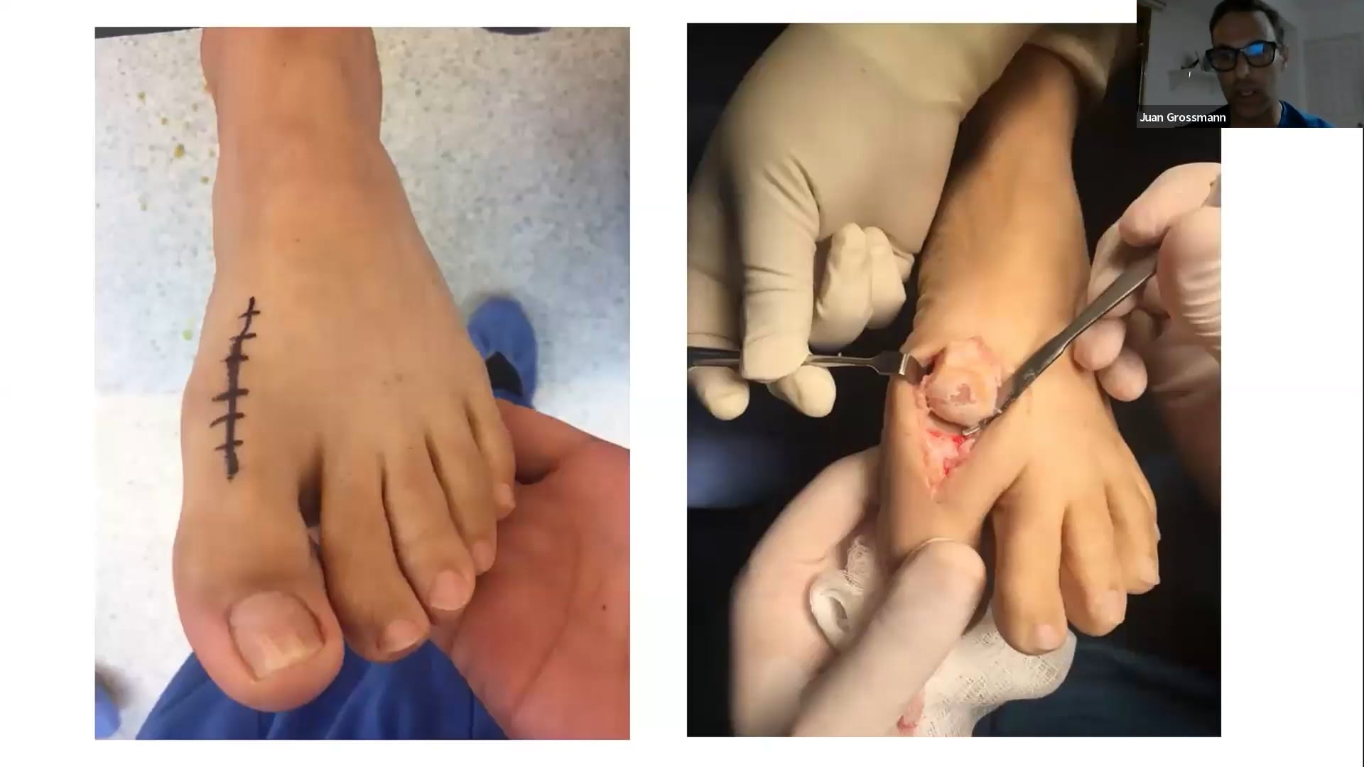 WEBINAR Manejo actual del HALLUX RIGIDUS en estadios avanzados