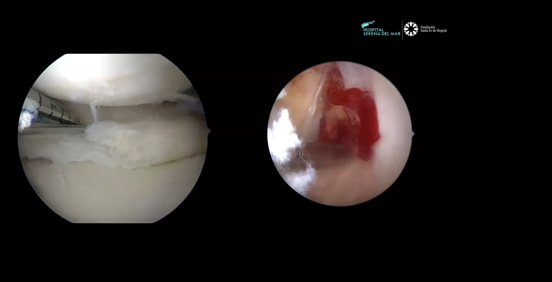 WEBINAR Lesiones Meniscales Compleja