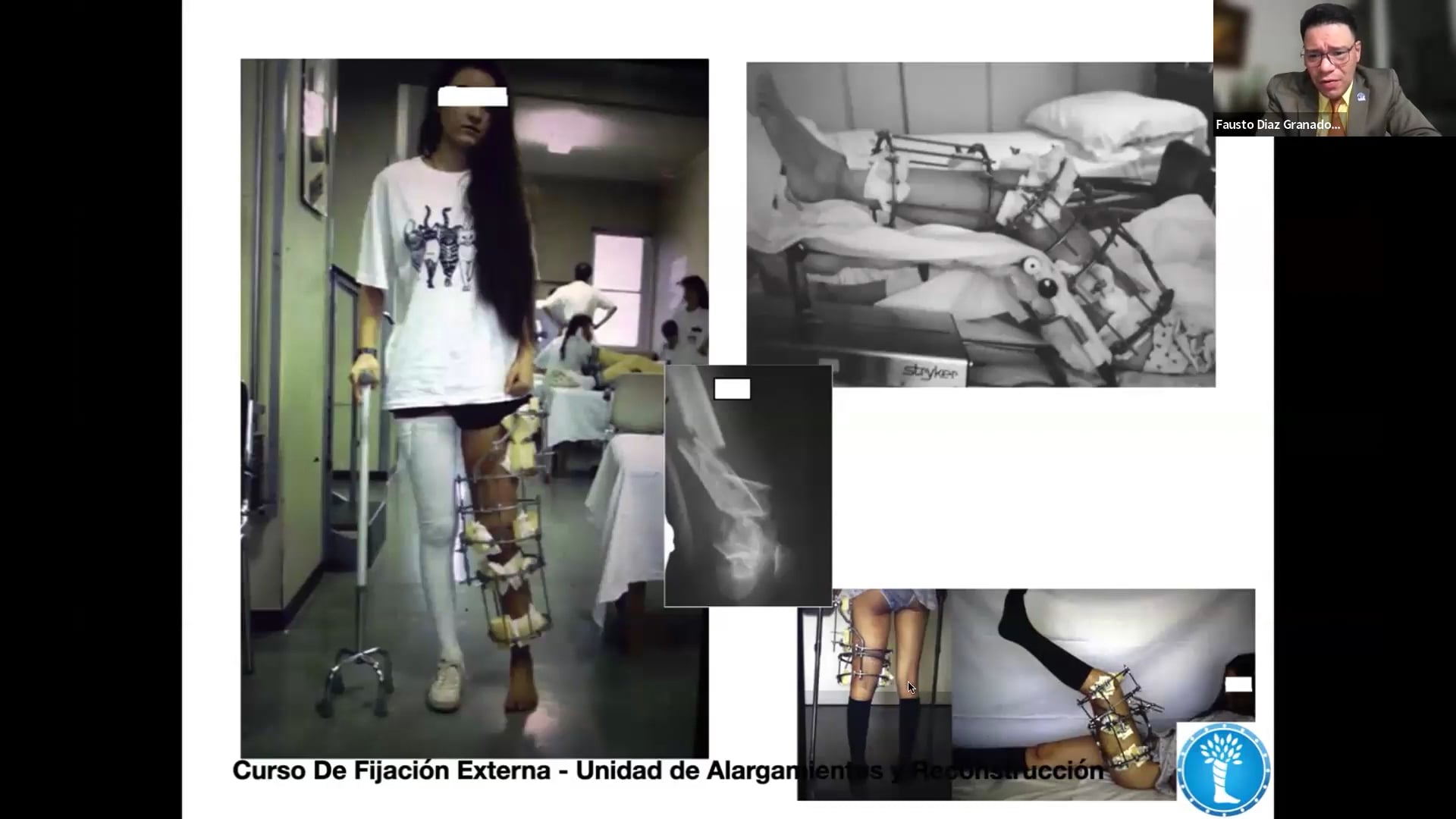 Webinar Tratamiento de fracturas de fémur distal con Fijación Externa final