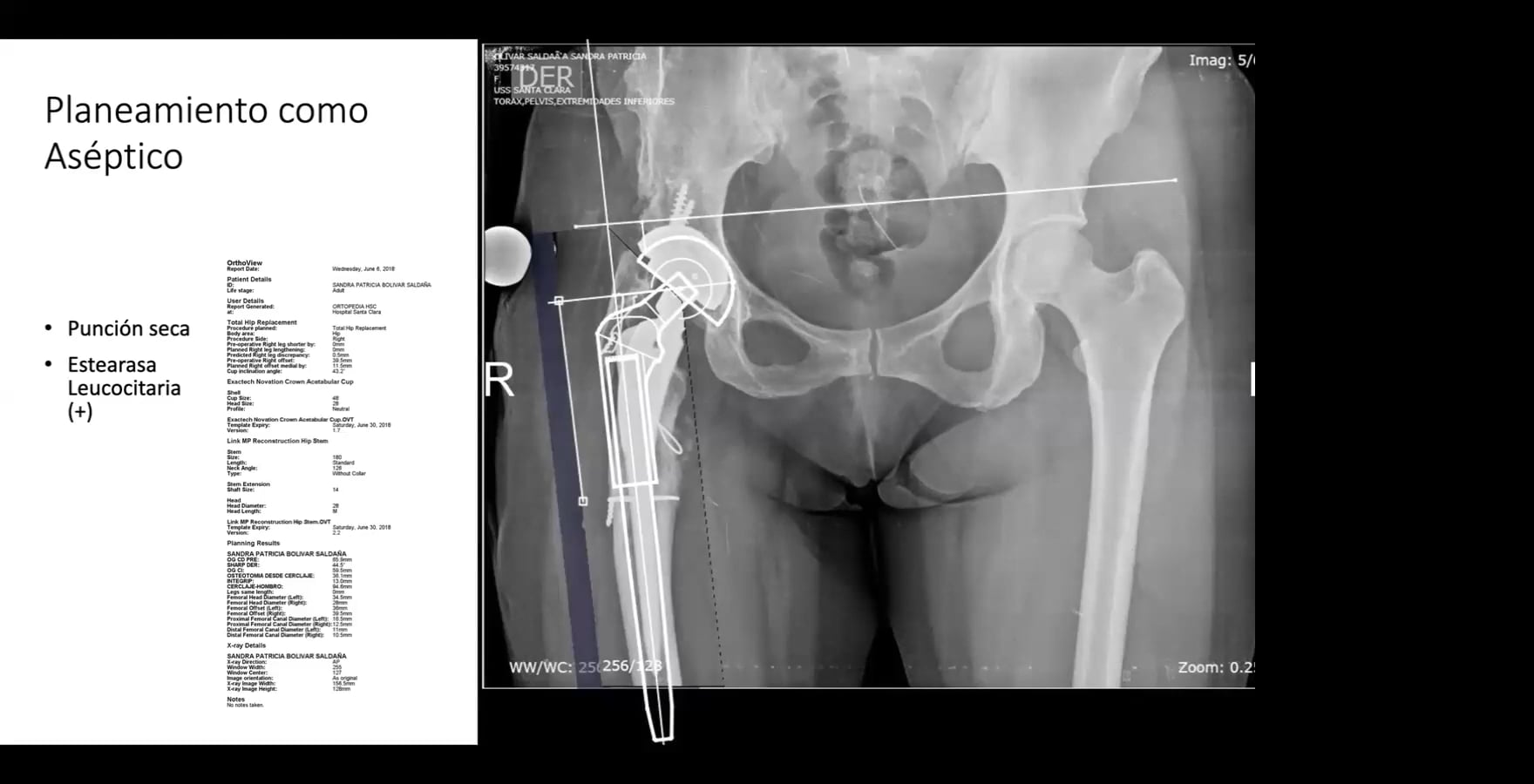 WEBINAR Grupo de discusión de casos clínicos en infección periprotésica final