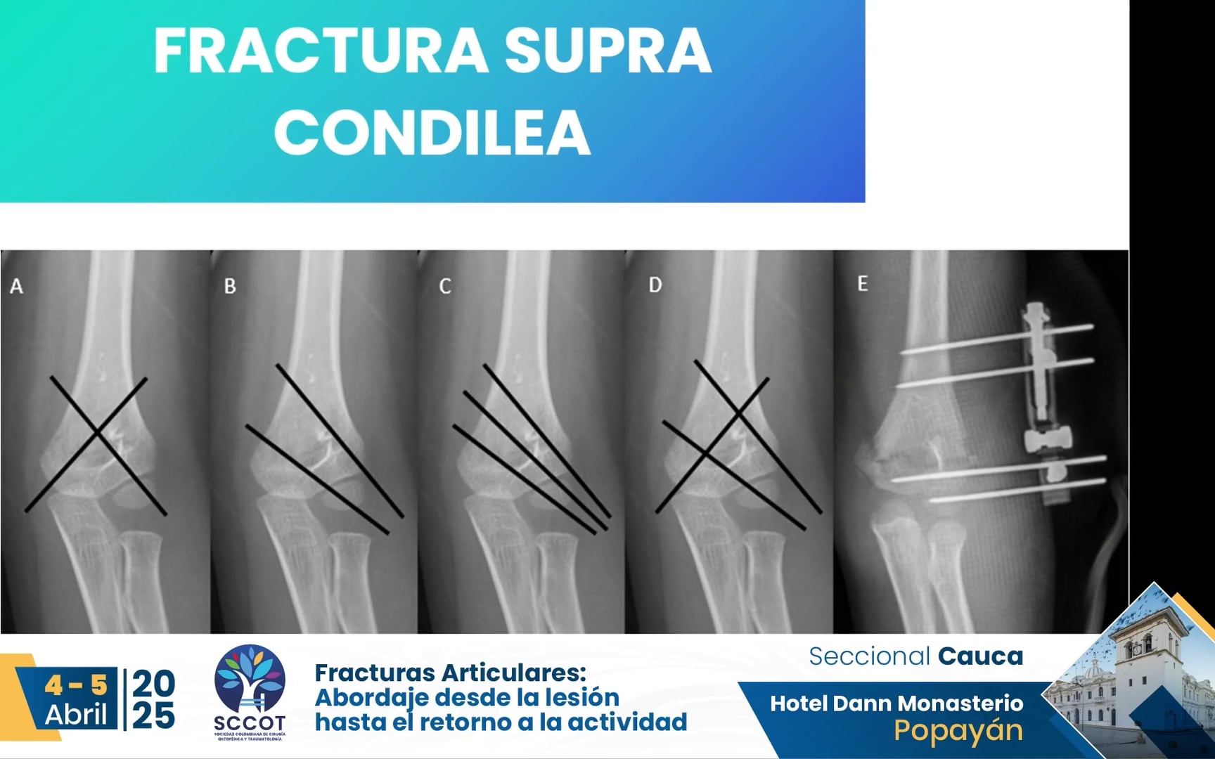 Lesiones traumáticas alrededor de las articulaciones del miembro superior del niño