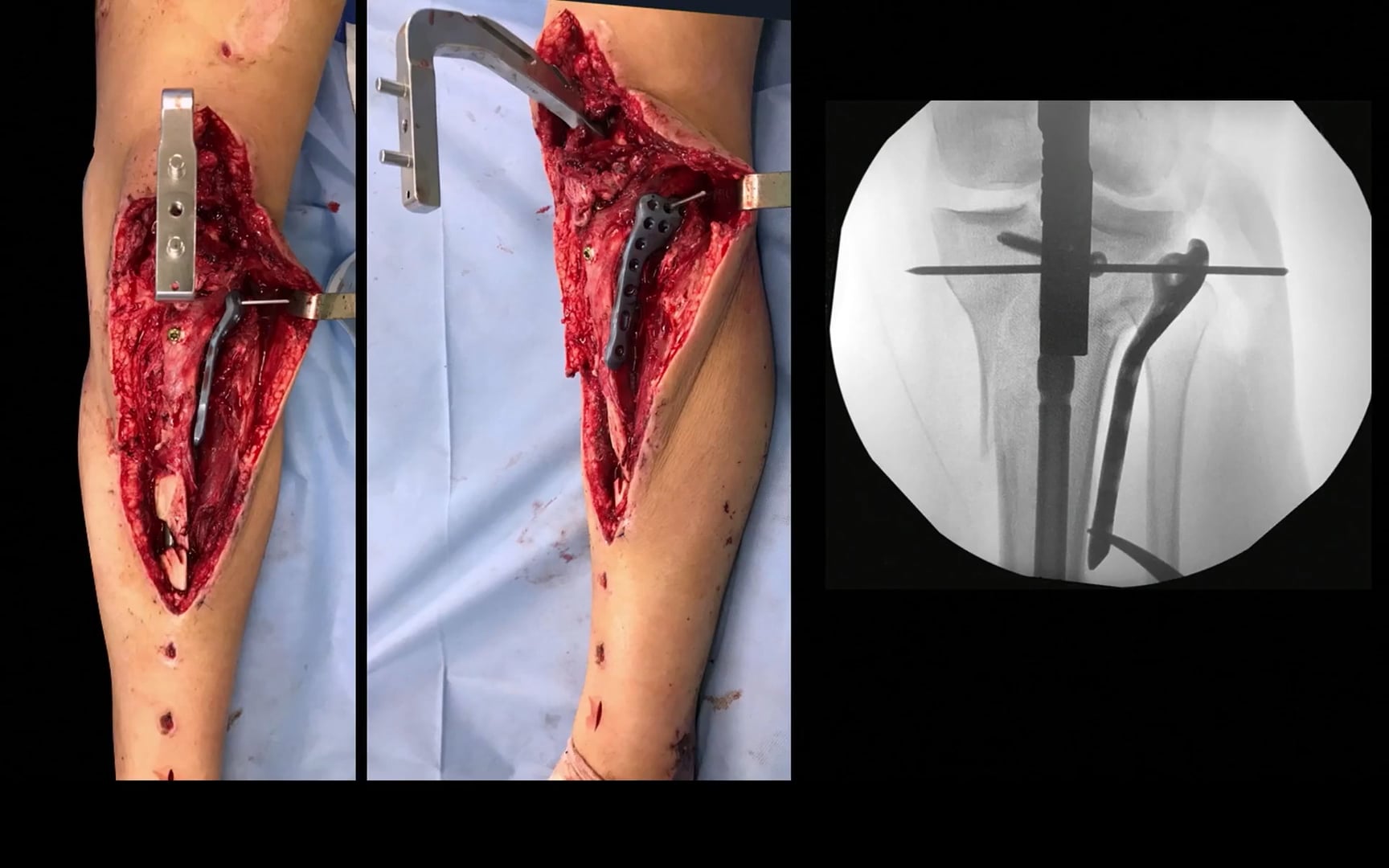 Manejo de los tejidos blandos pre, trans y postoperatorios en fracturas articulares