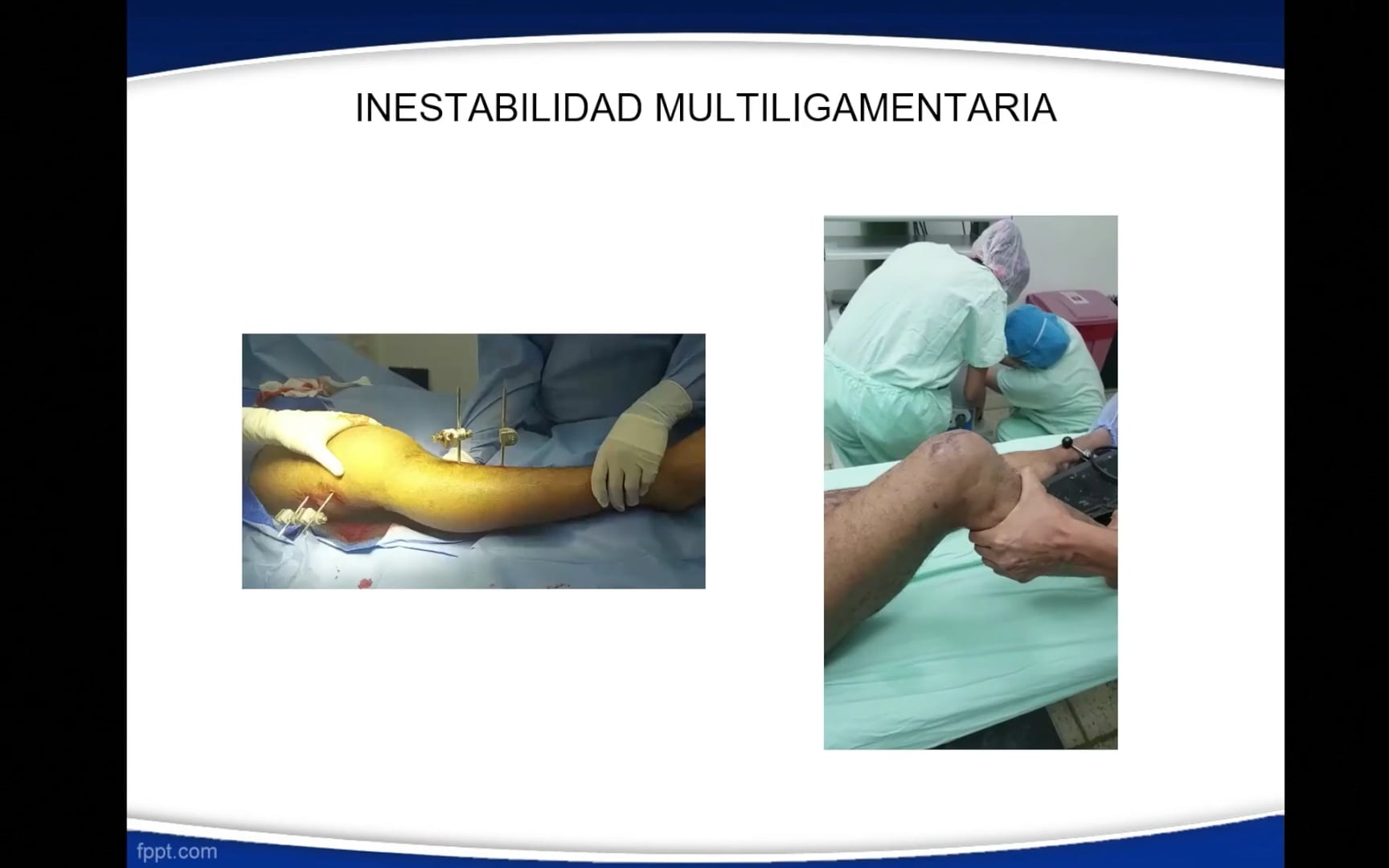 Mecanismo de trauma y examen físico completo de una lesión de rodilla