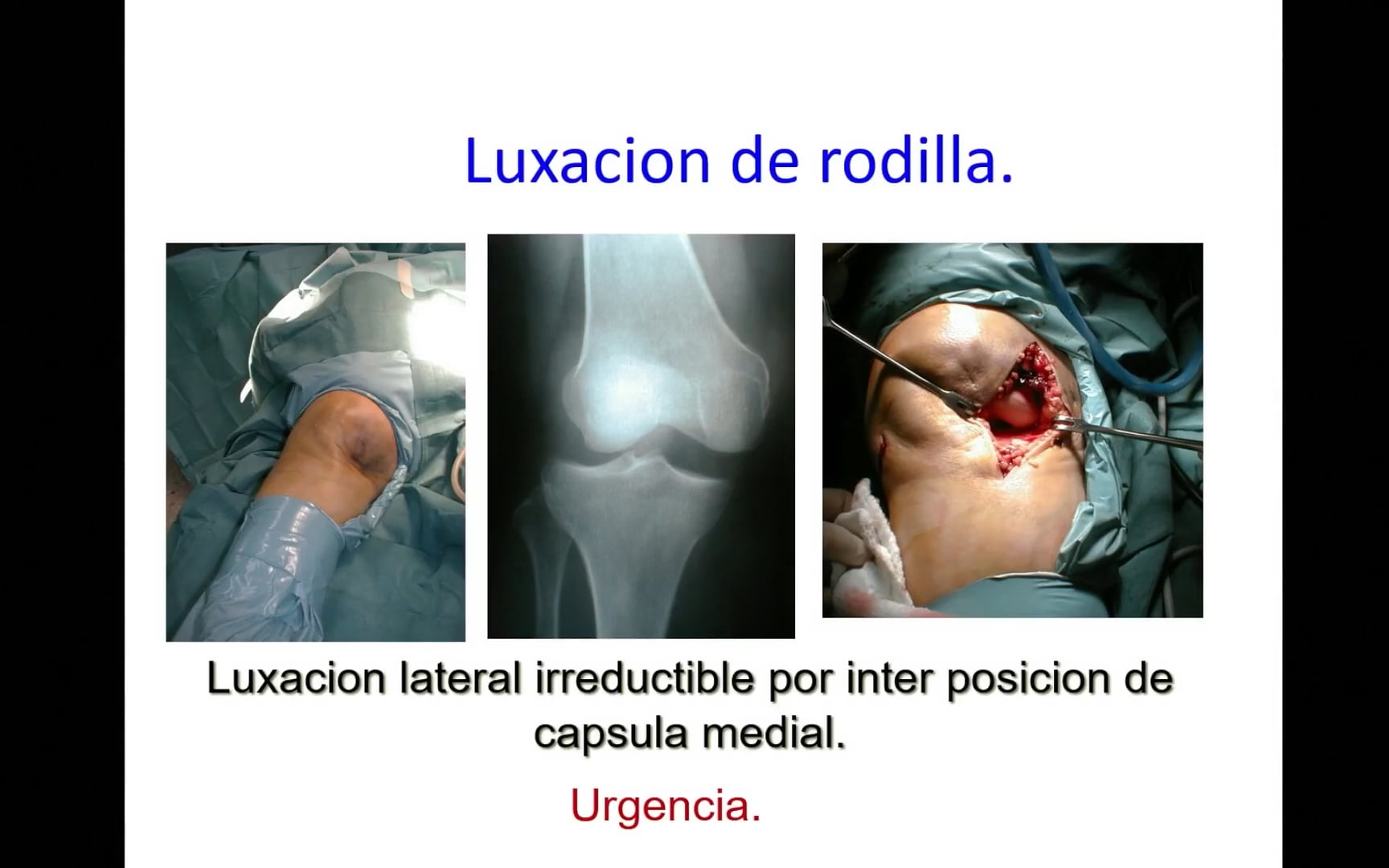 Estudios imagenológicos para una evaluación completa del trauma de rodilla