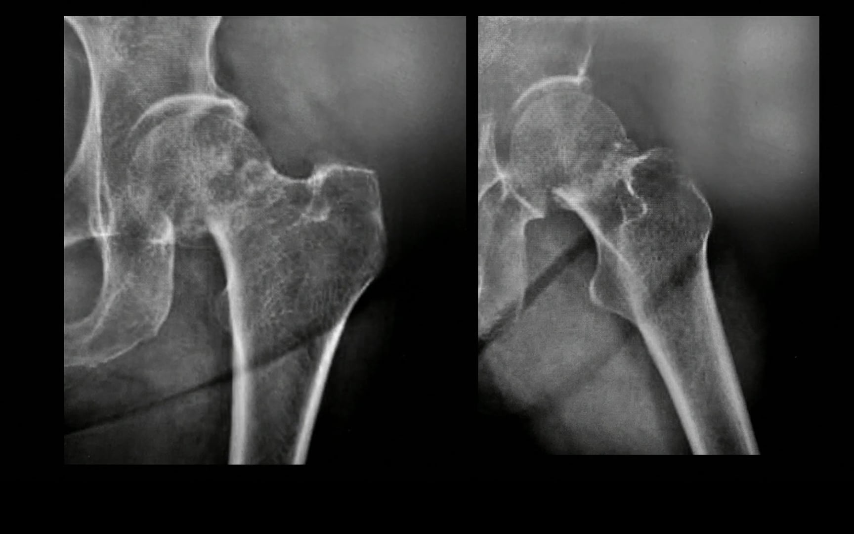 Tratamiento de las fracturas y-o luxaciones de la cadera