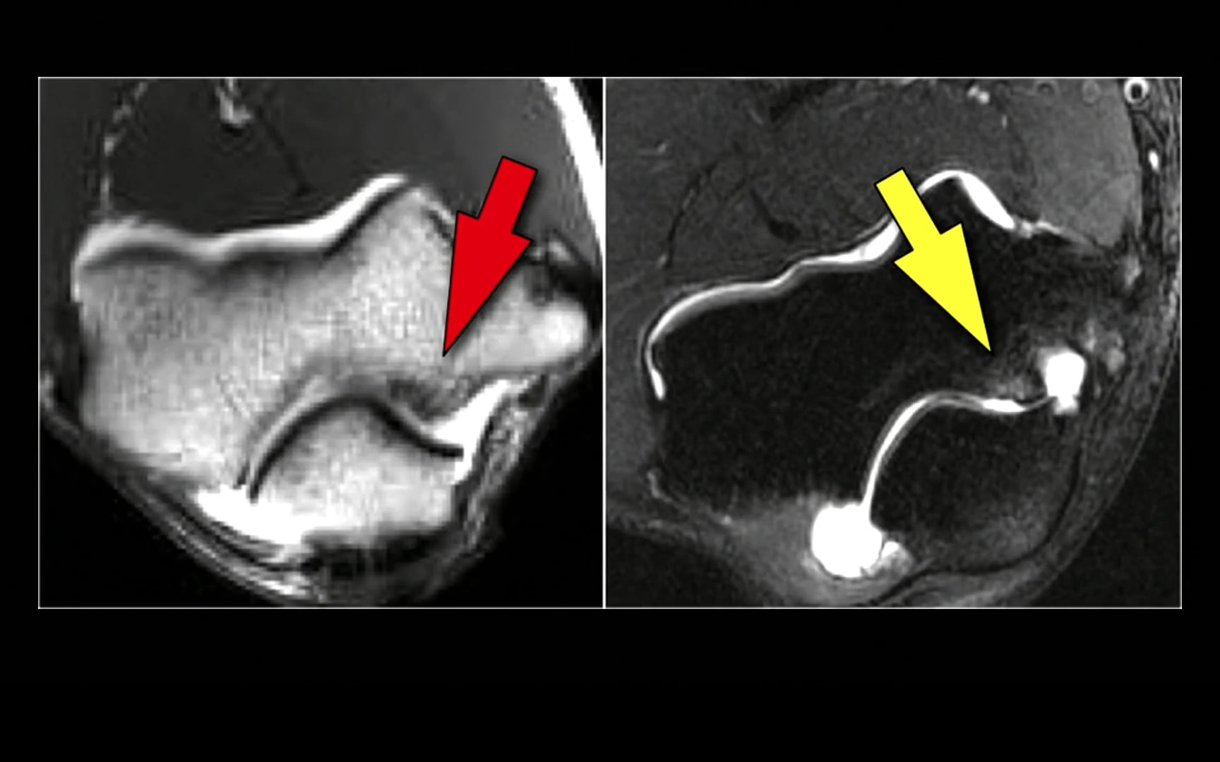 Estudios imagenológicos para una evaluación completa del trauma de codo