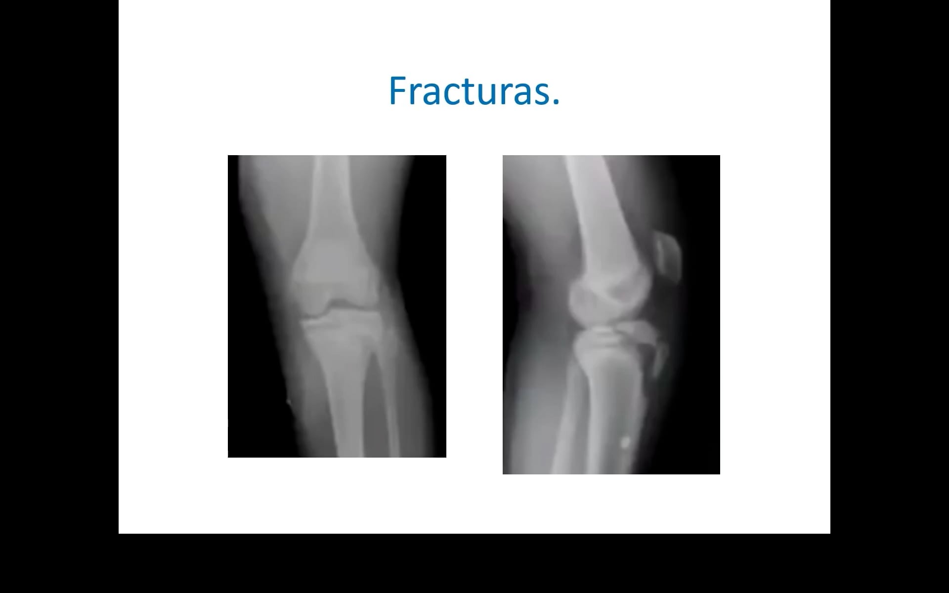 Lesiones traumáticas alrededor de la rodilla del niño