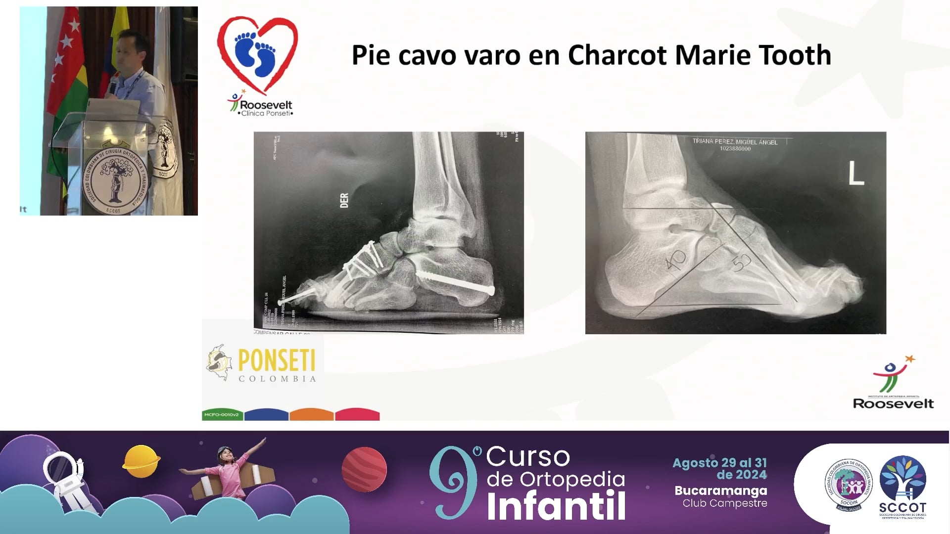 Nuevo enfoque del tratamiento del pie equino varo neurológico