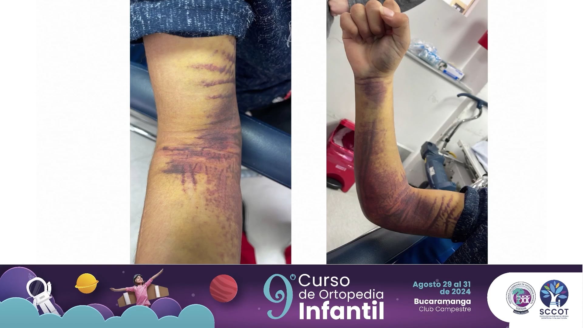 Fractura de cúpula radial, Cuál es la mejor opción de tratamiento