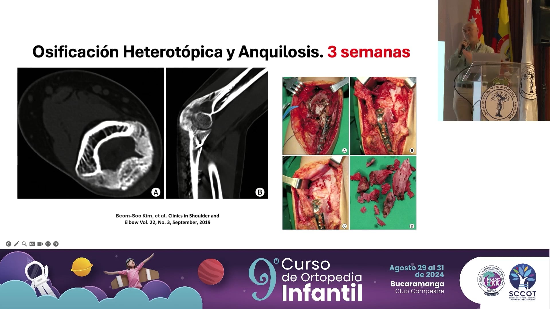 Fracturas del olecranon. Cómo resolverlas