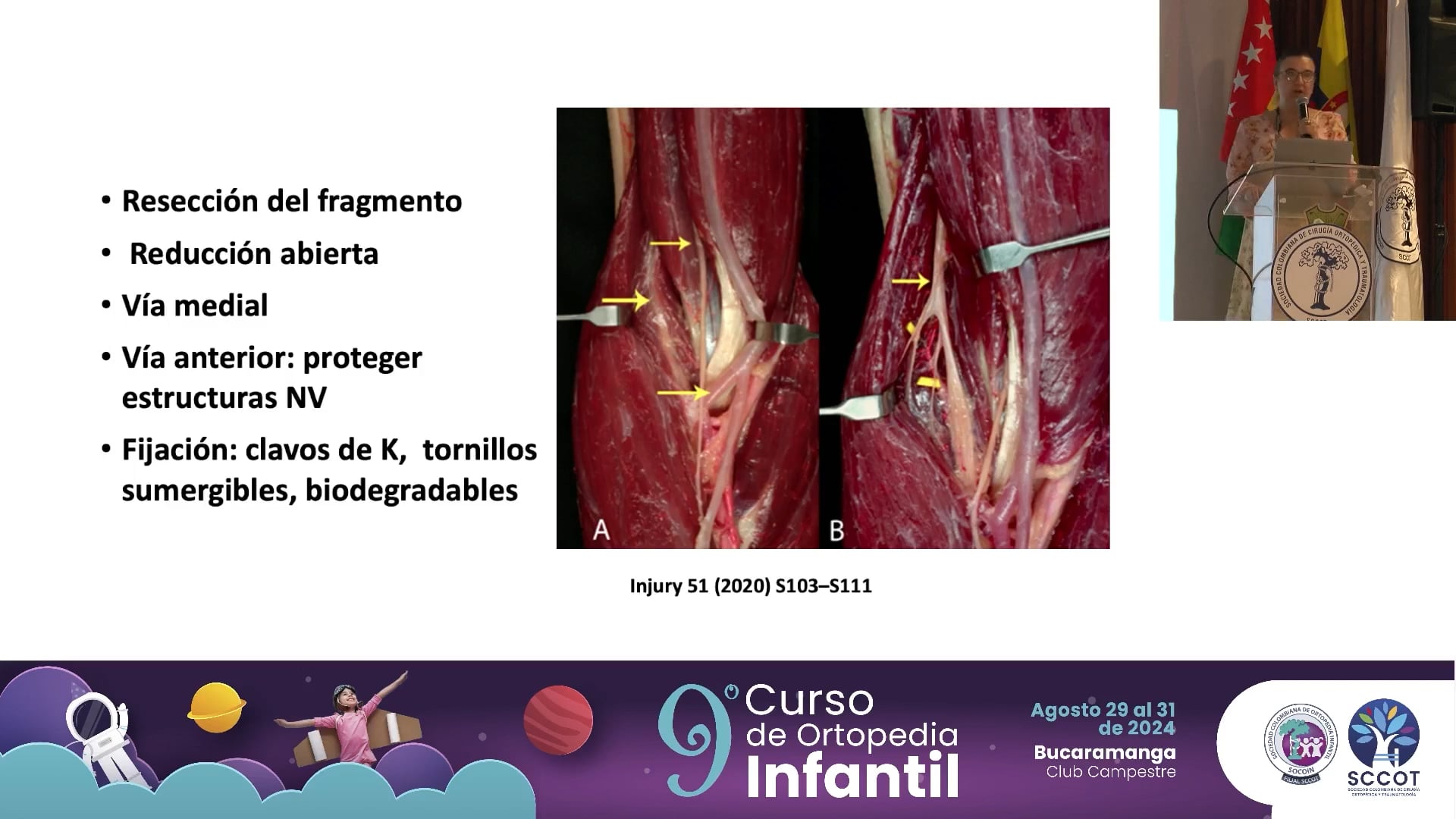 Fracturas de la tróclea. Estado del arte