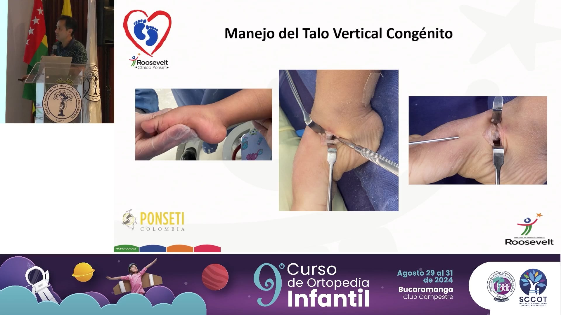 Talo vertical congénito