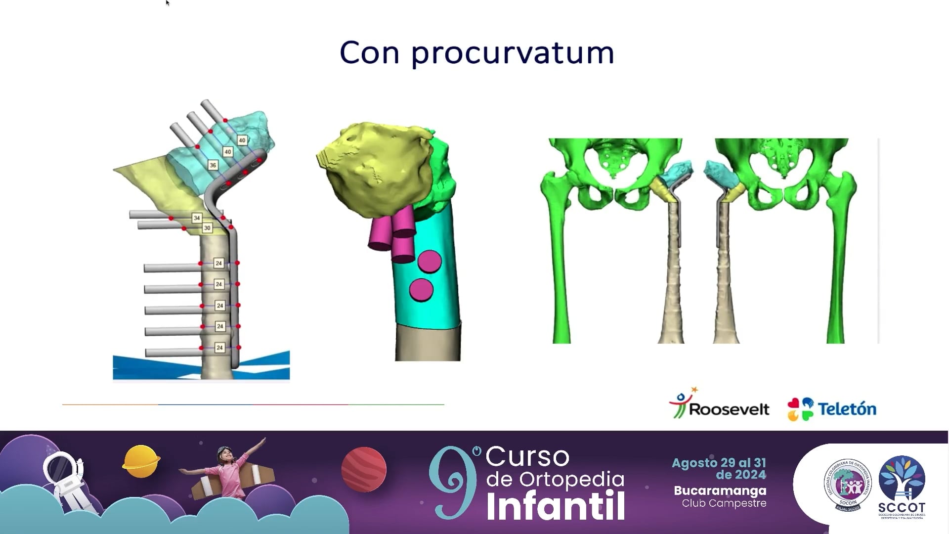 Soporte pélvico con placas