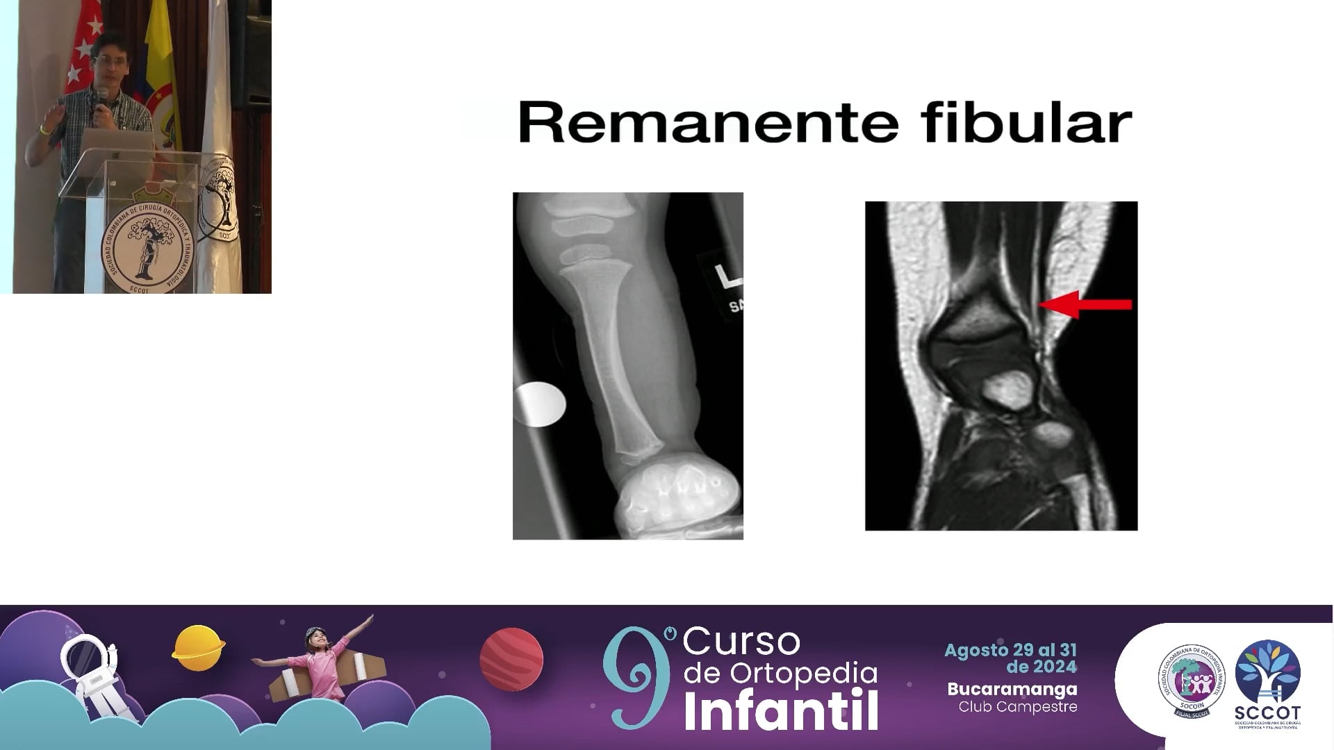 Hemimelia fibular ┬┐Reconstruir o amputar?