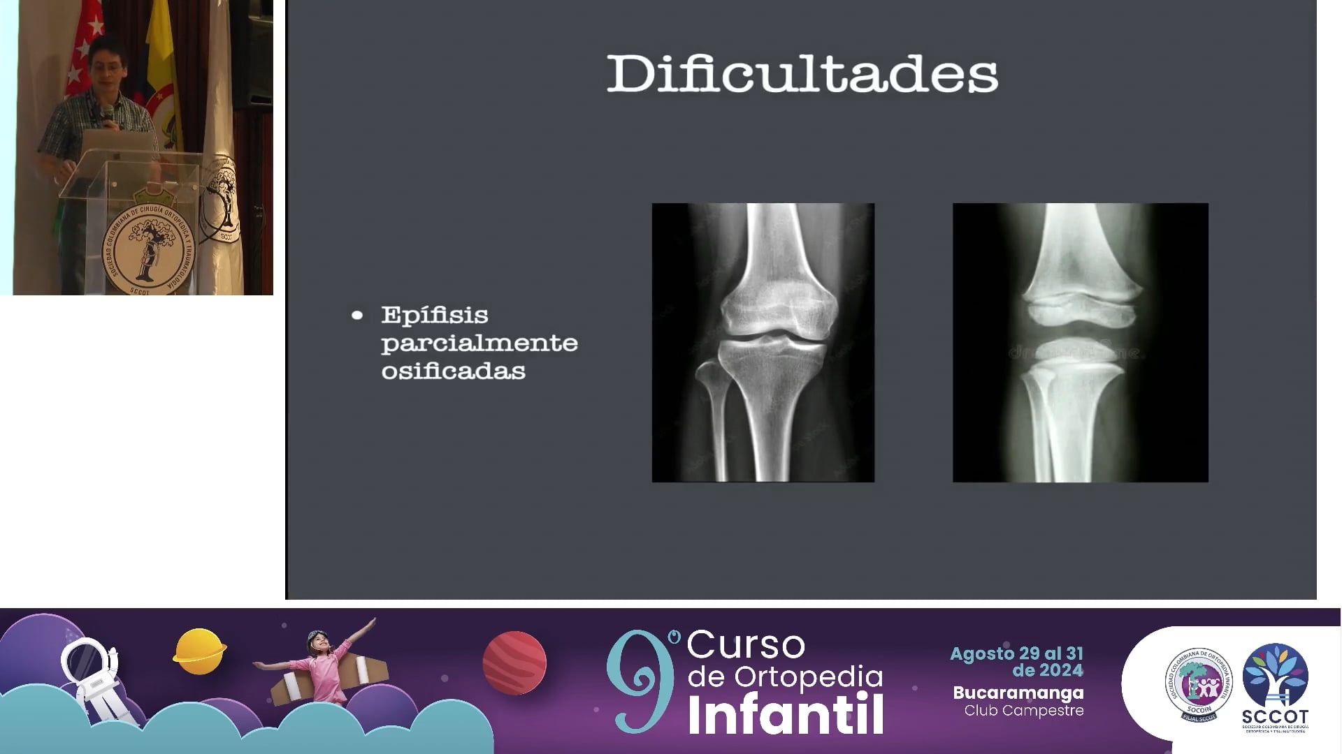Planeamiento de osteotomías en la tibia infantil