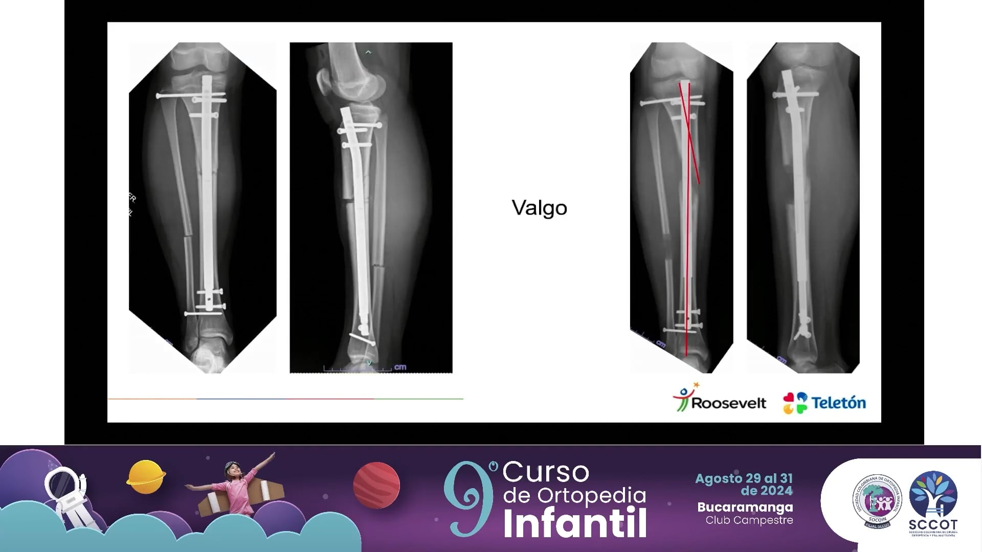 Alargamiento endomedular, planeamiento, ejecución y complicaciones
