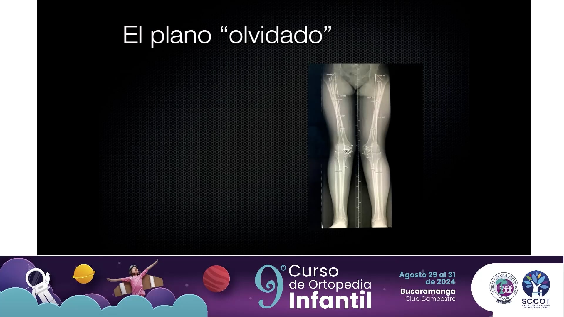 Planeamiento de osteotomías en el plano sagital