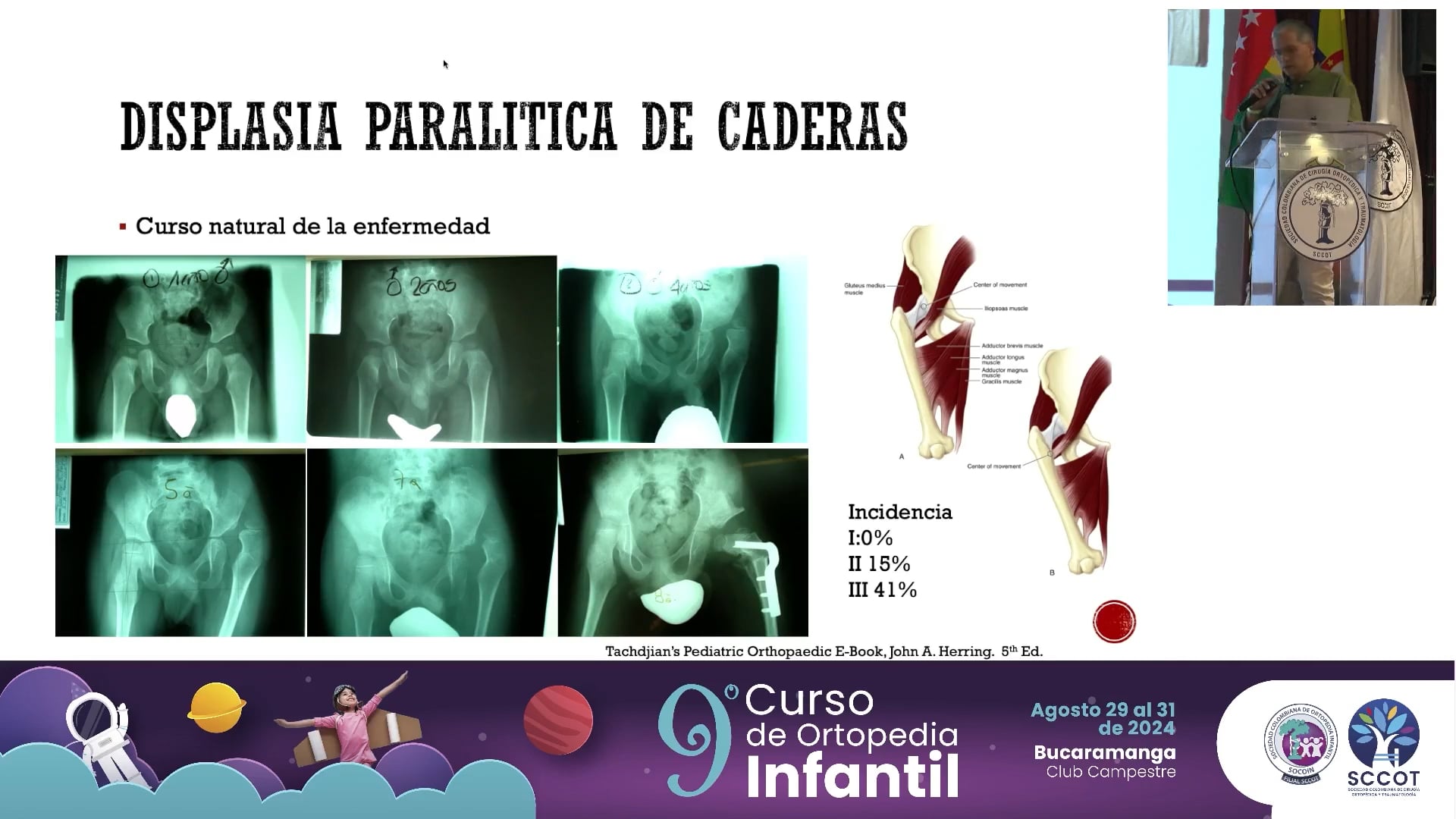 Parálisis cerebral grupo funcional I-II-III