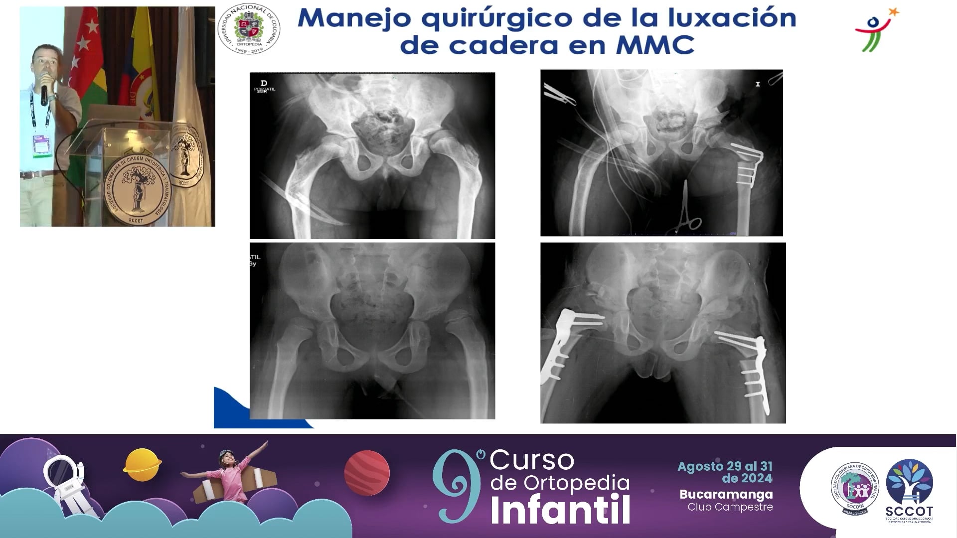 Las caderas en mielomeningocele ┬┐Al fin cuando operarlas?