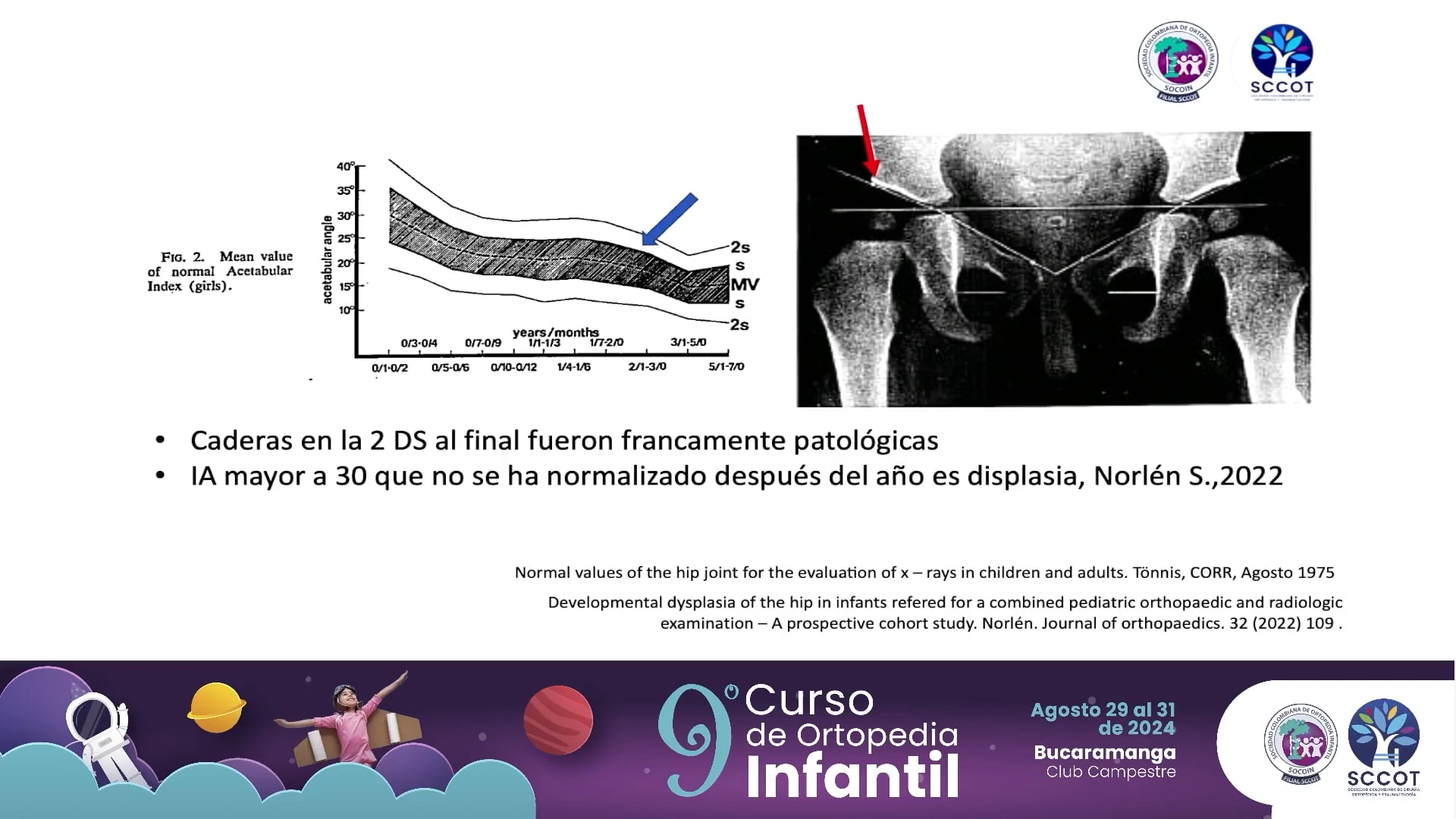Diagnóstico radiológico de displasia de caderas.