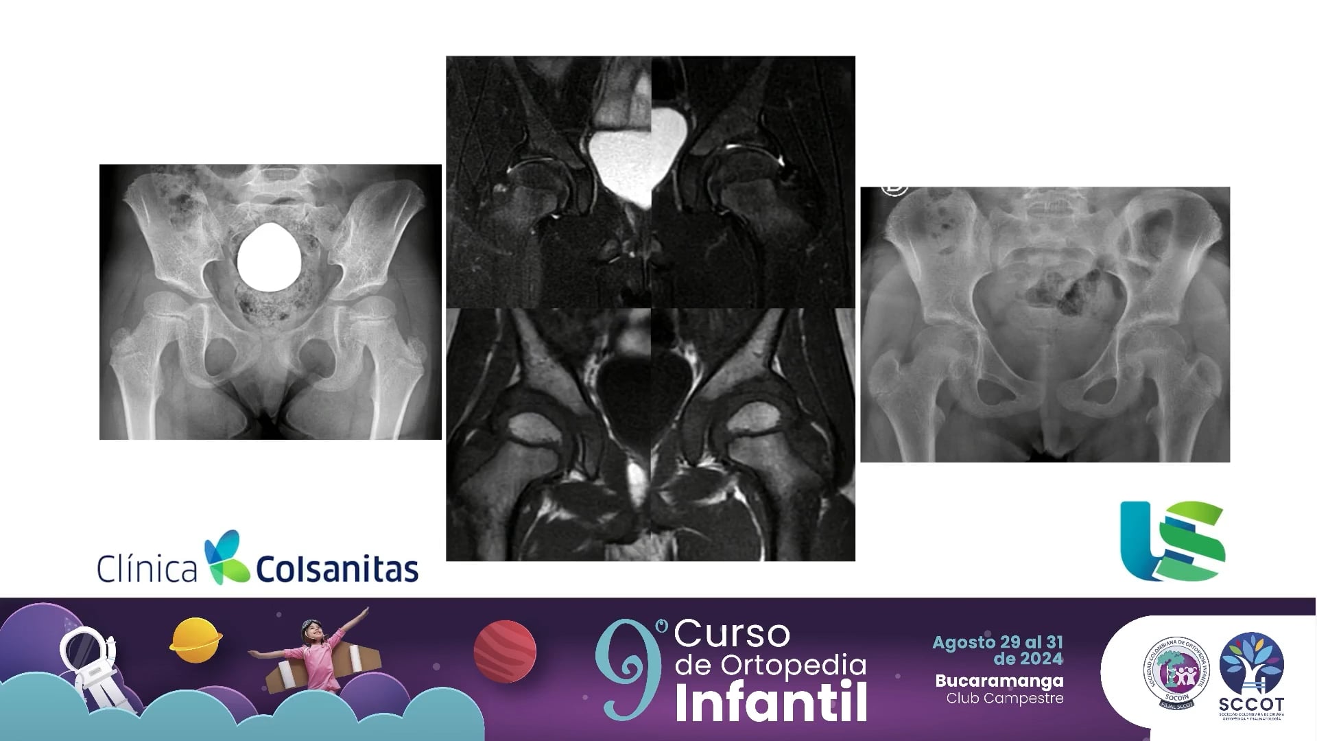 Importancia de la R.N.M. en displasia de caderas.