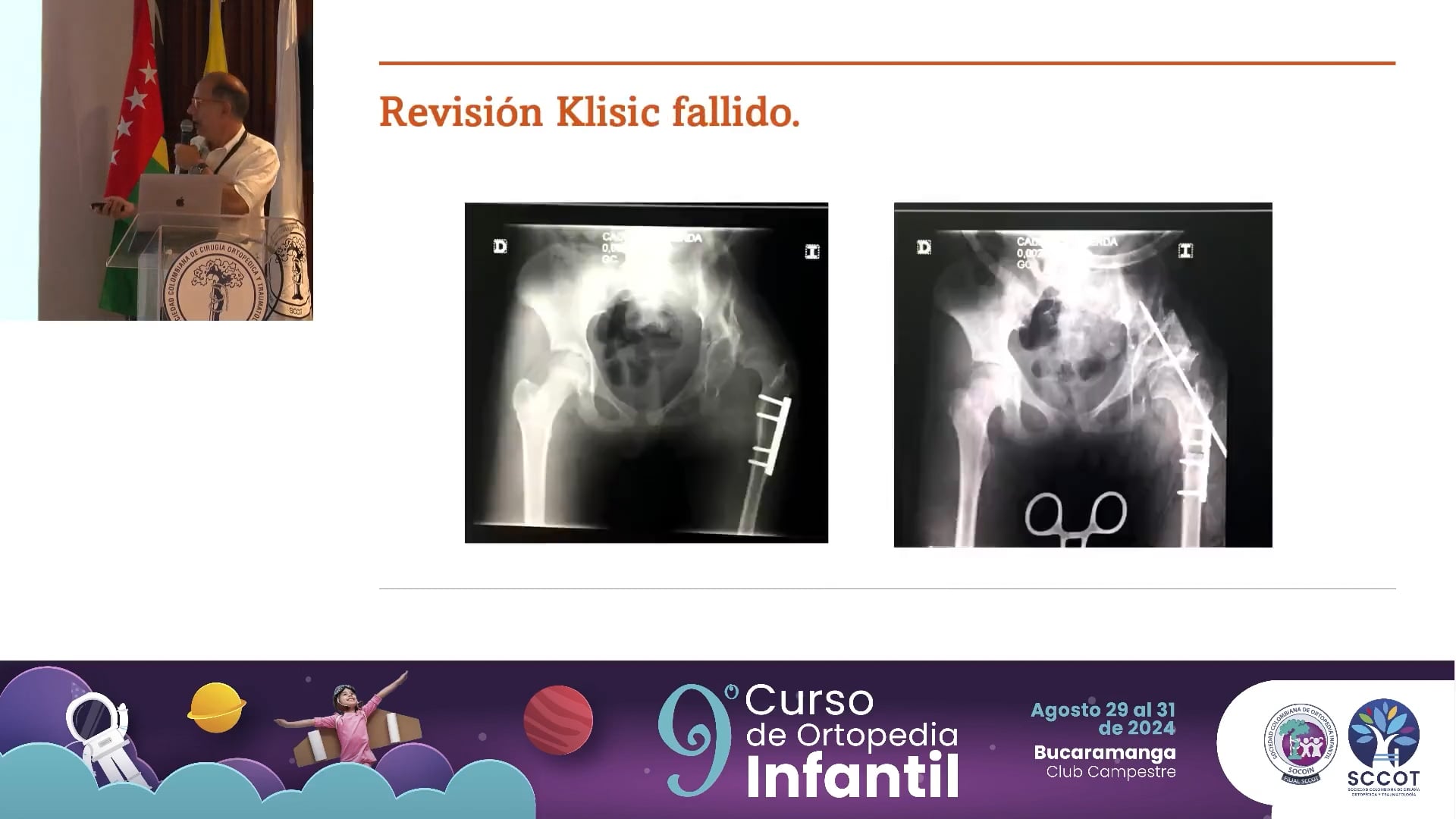 Cirugía en luxación de caderas en niños mayores de 3 años