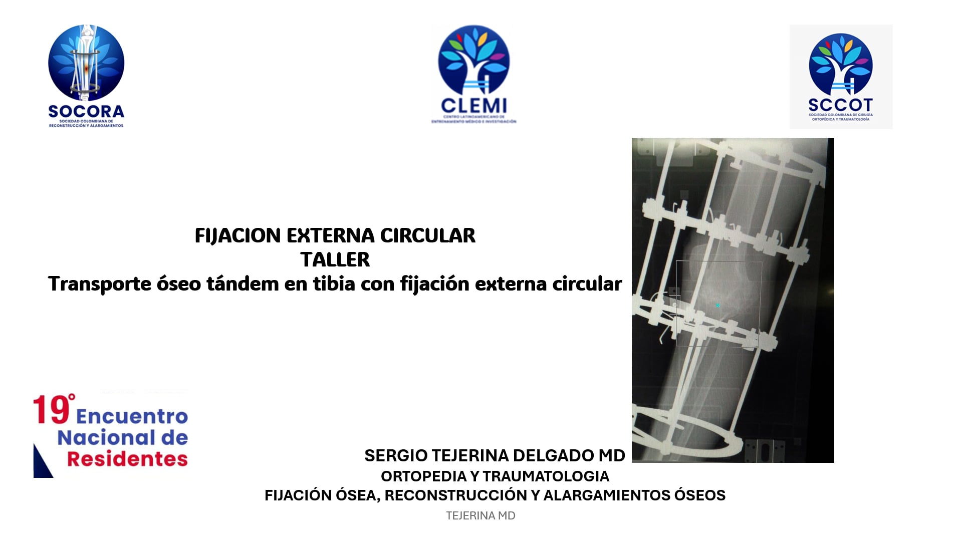 Transporte óseo tándem en tibia con fijación externa circular