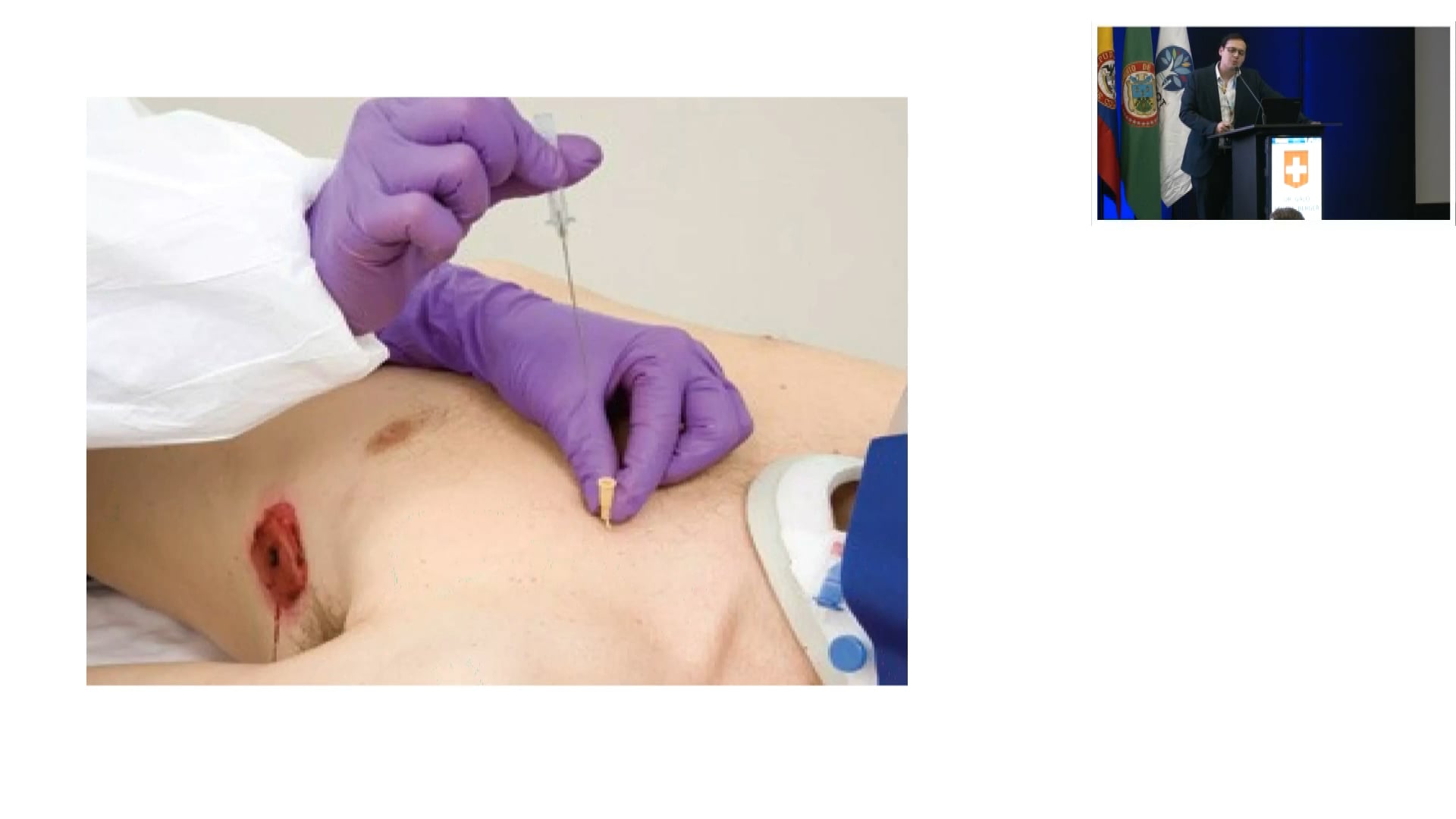 Trauma toraco abdominal y fijación de fracturas