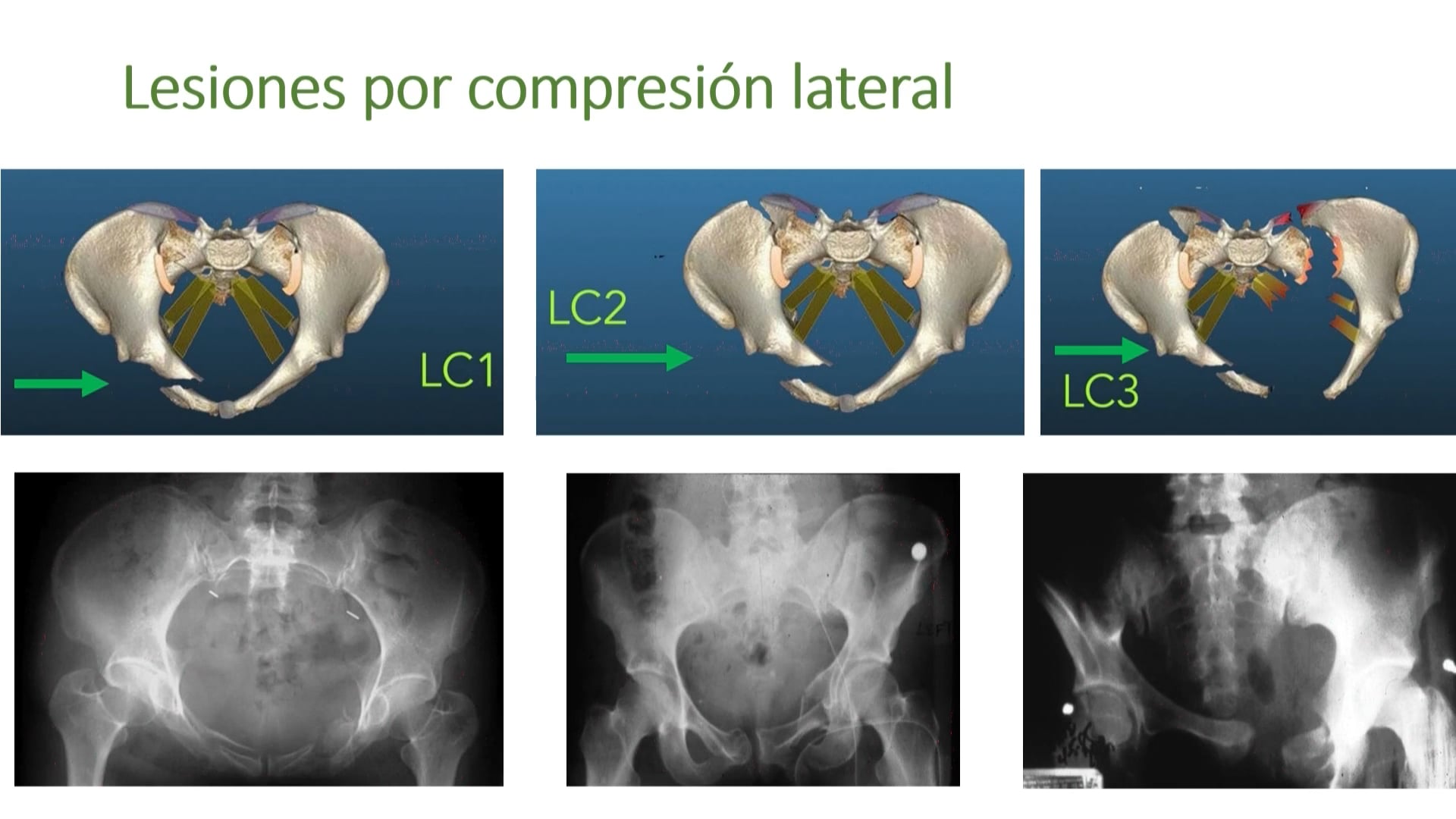 Lesiones inestables del anillo pélvico