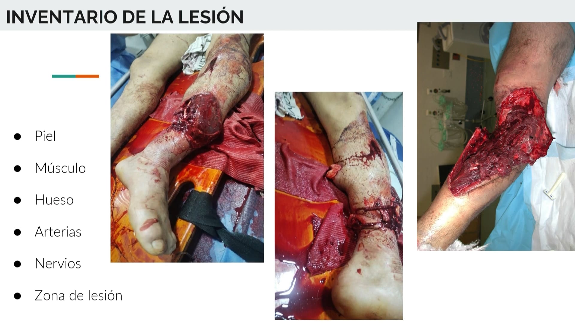 Manejo de lesiones graves en extremidades