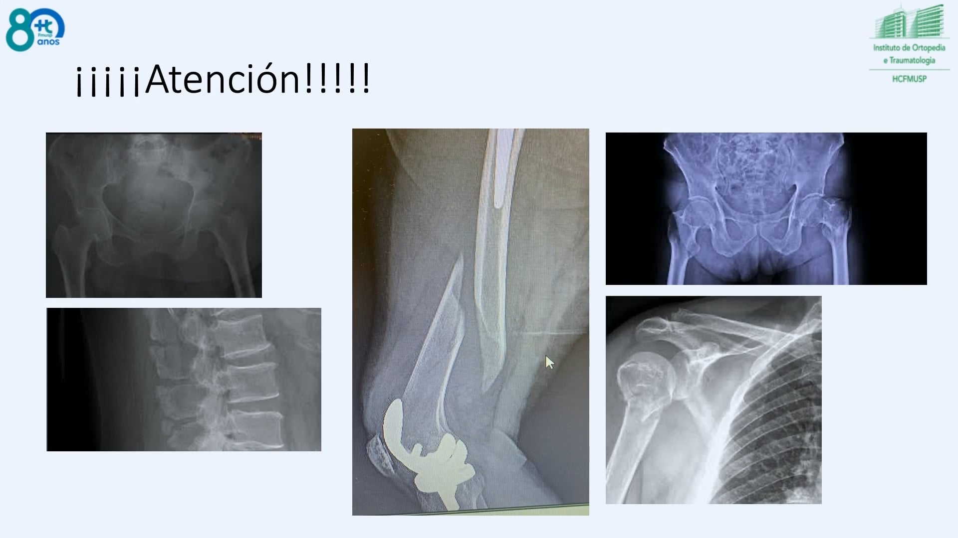 Las fracturas por fragilidad son o no una epidemia
