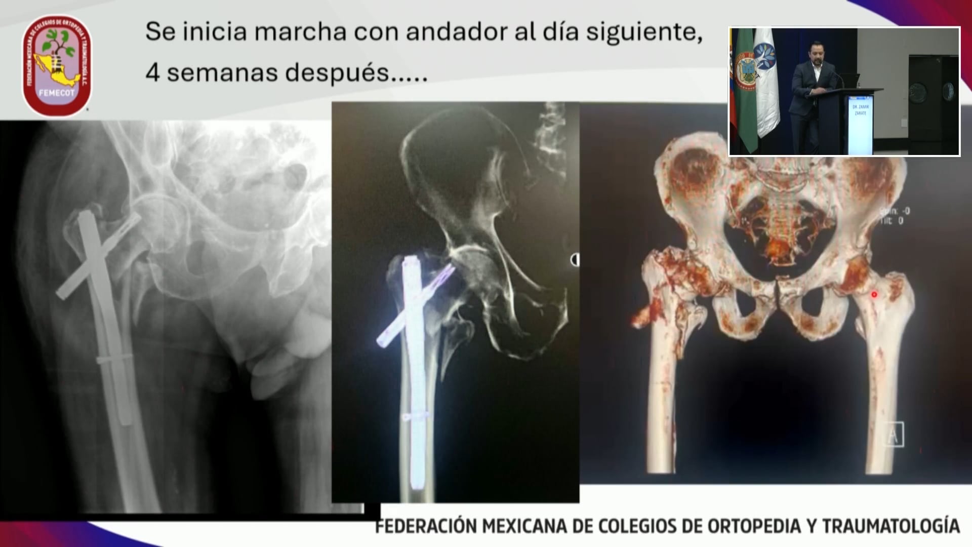 Efecto de la edad y el envejecimiento en la consolidación de fracturas