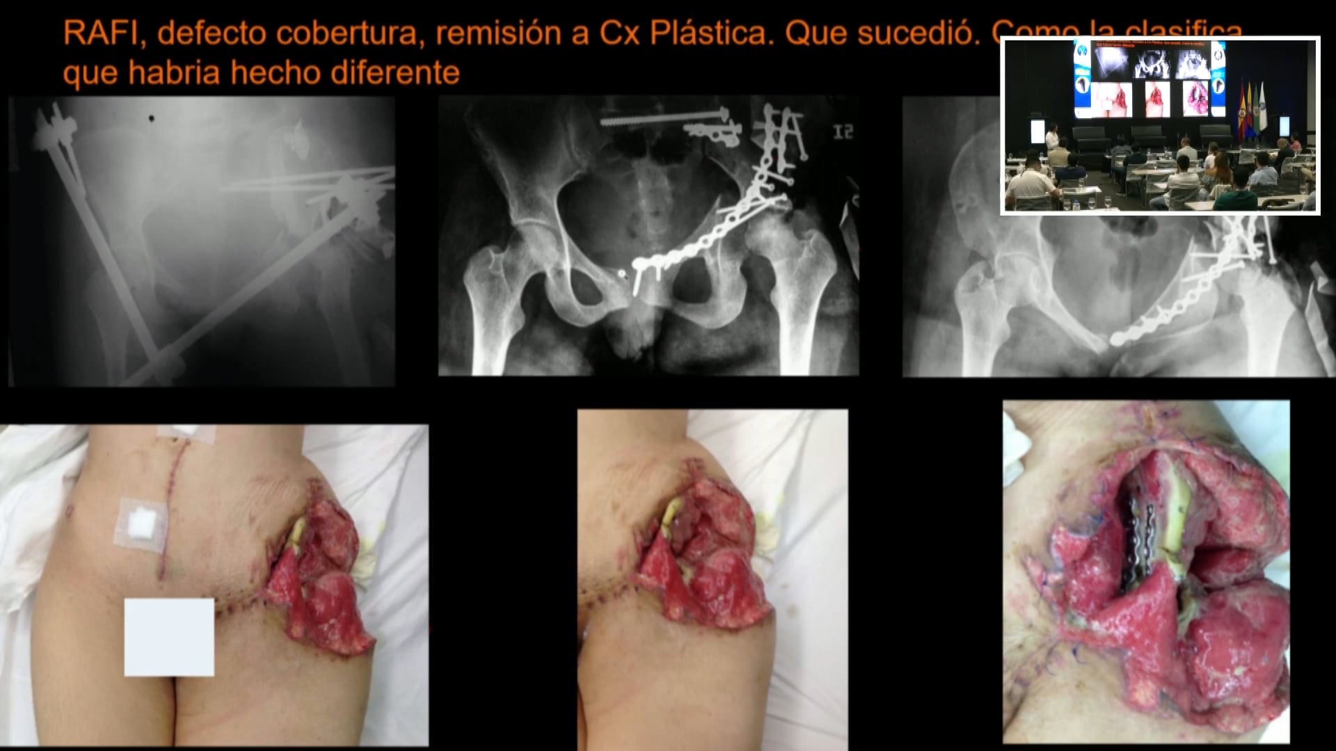 Caso 1. Fractura abierta IIIB