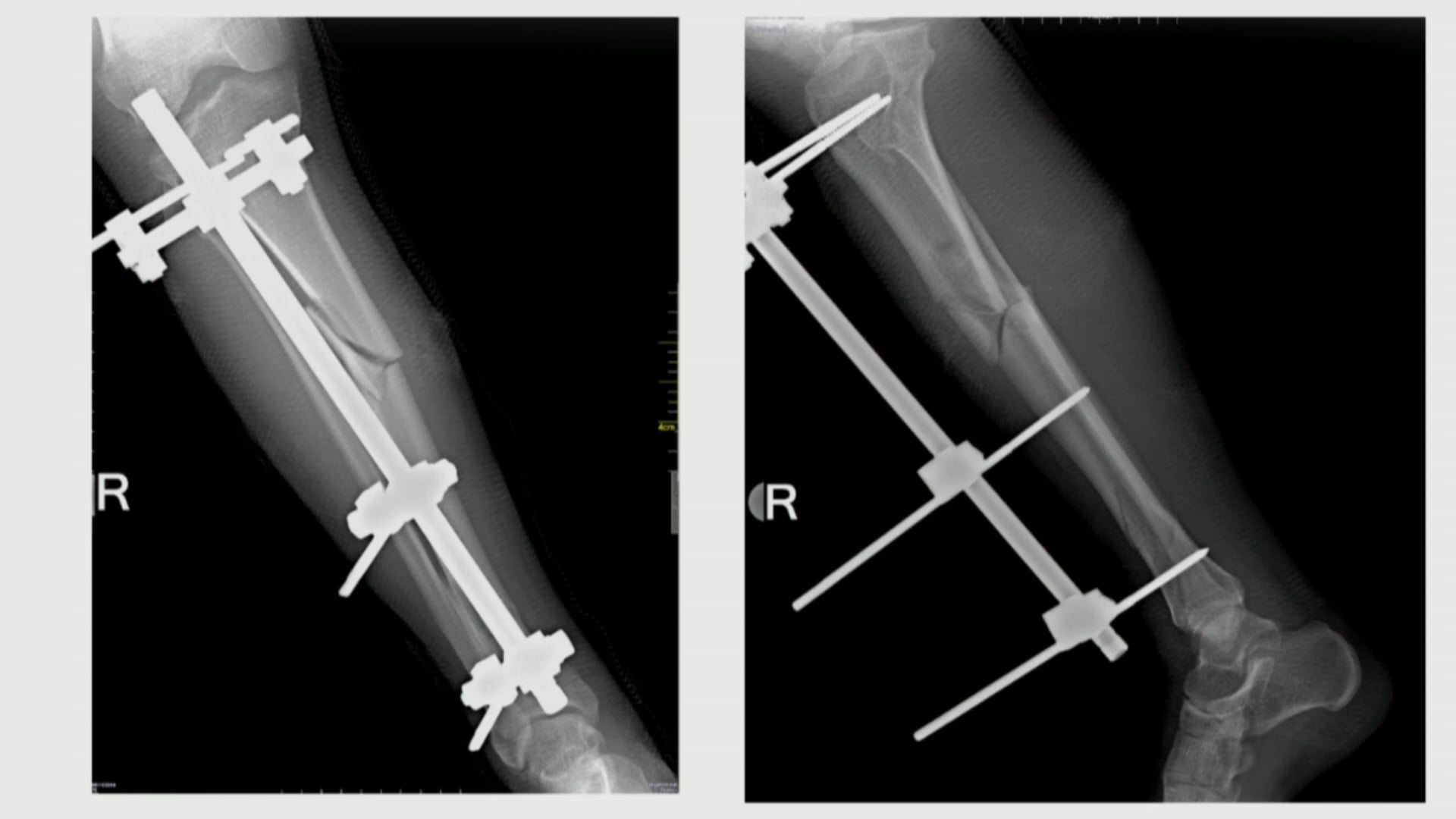 Mito 2. El clavo retrógrado de fémur y el suprapatelar de tibia dañan la rodilla