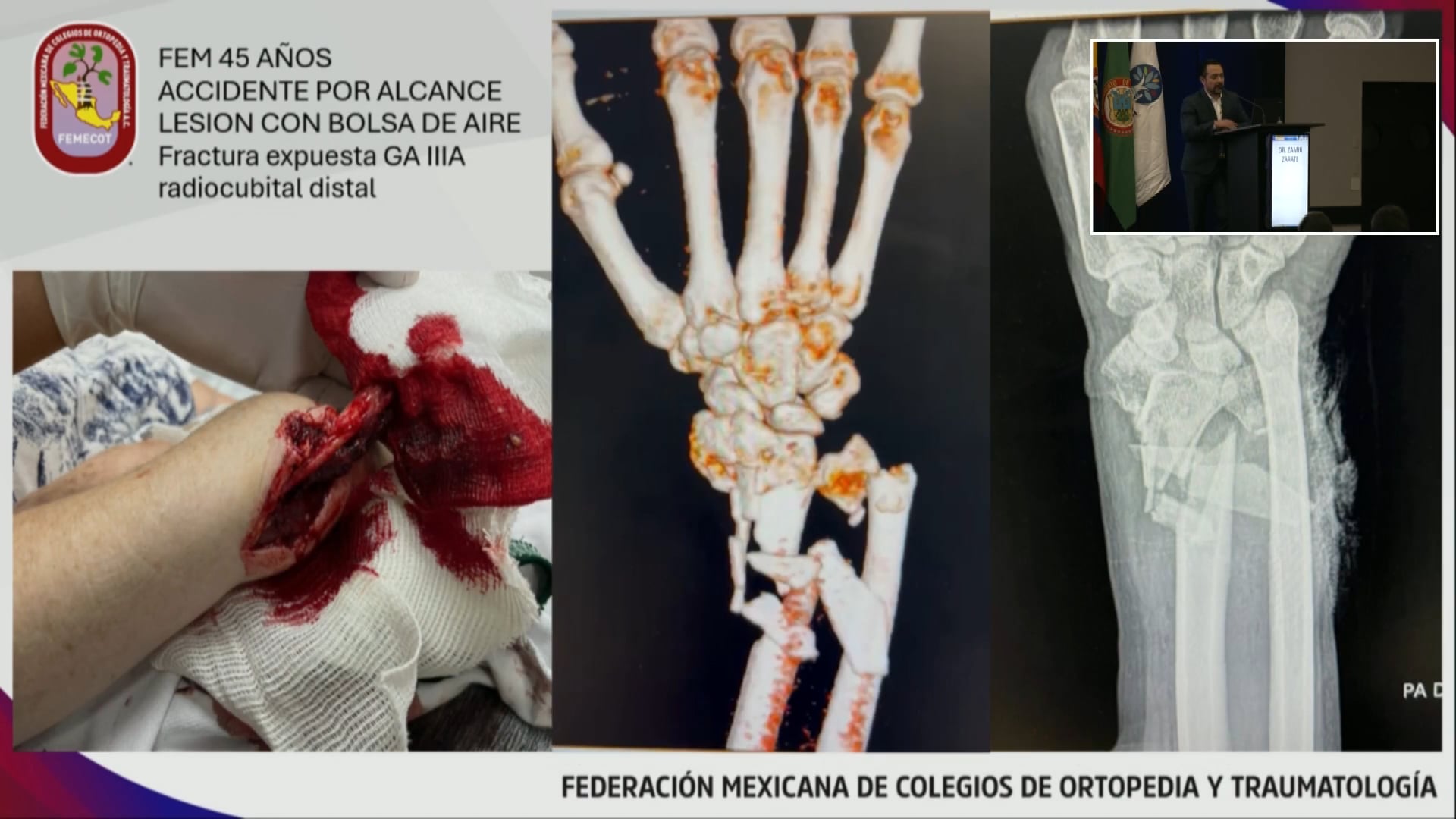 Técnicas de manejo adecuado de los tejidos blandos