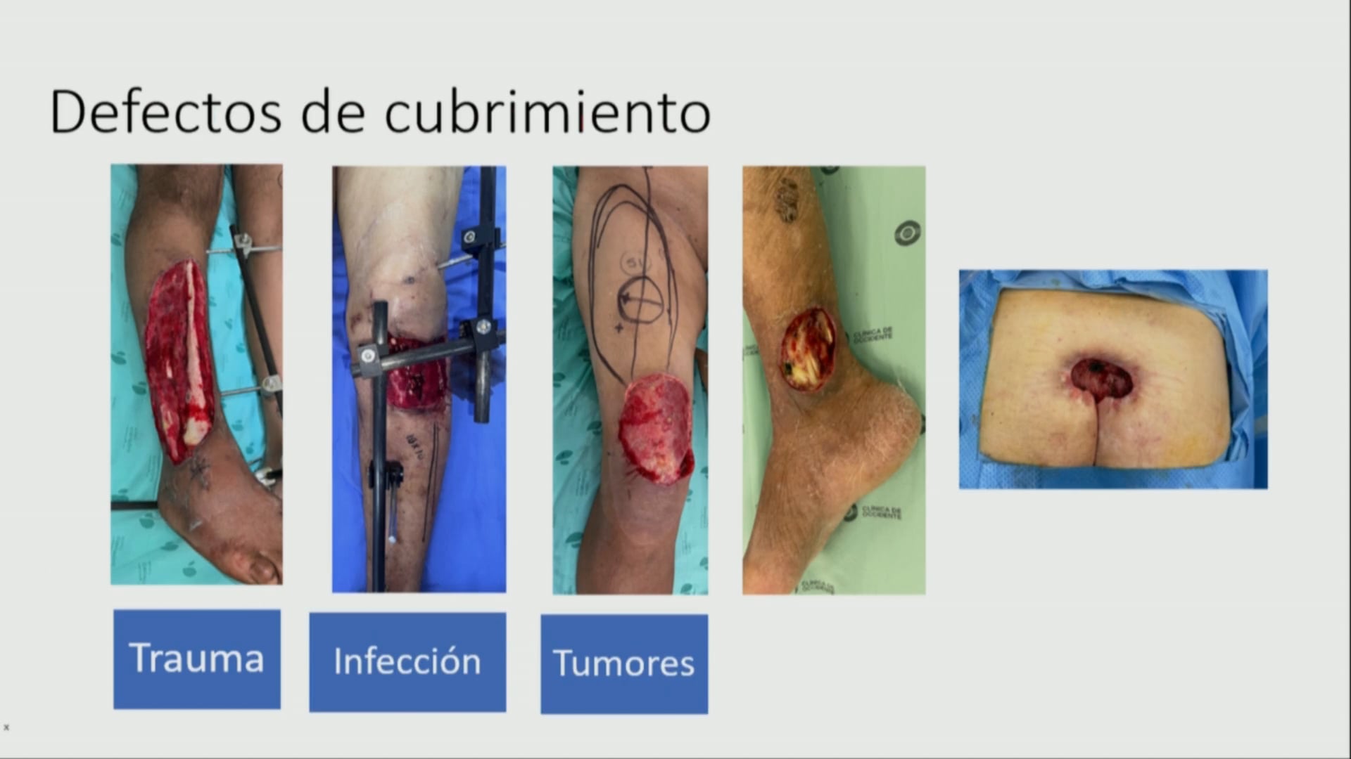 Definiendo lo básico Injertos EP y ET y colgajos Locales y libres