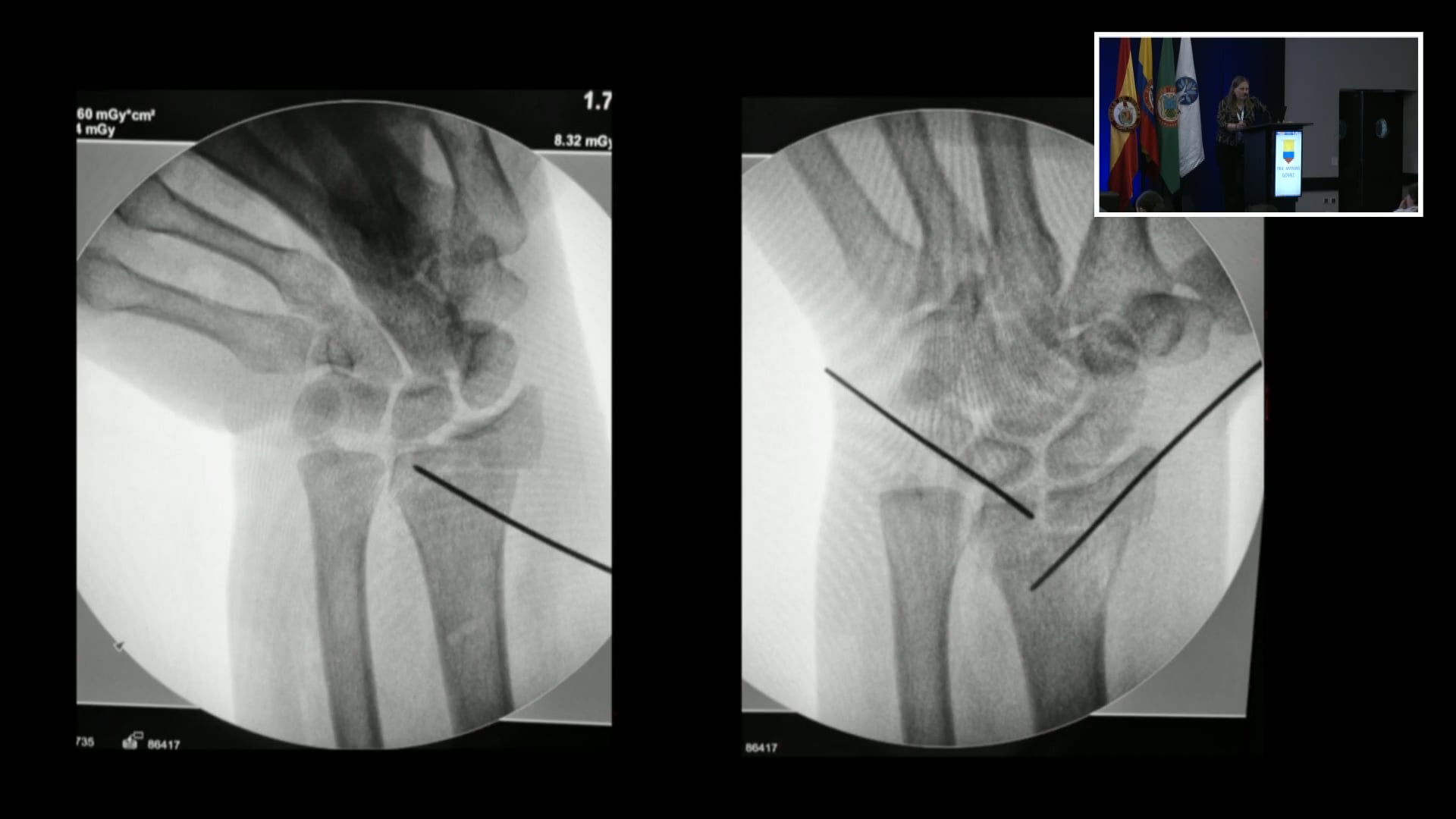 Implantes para fragmentos específicos, su uso mejora desenlaces