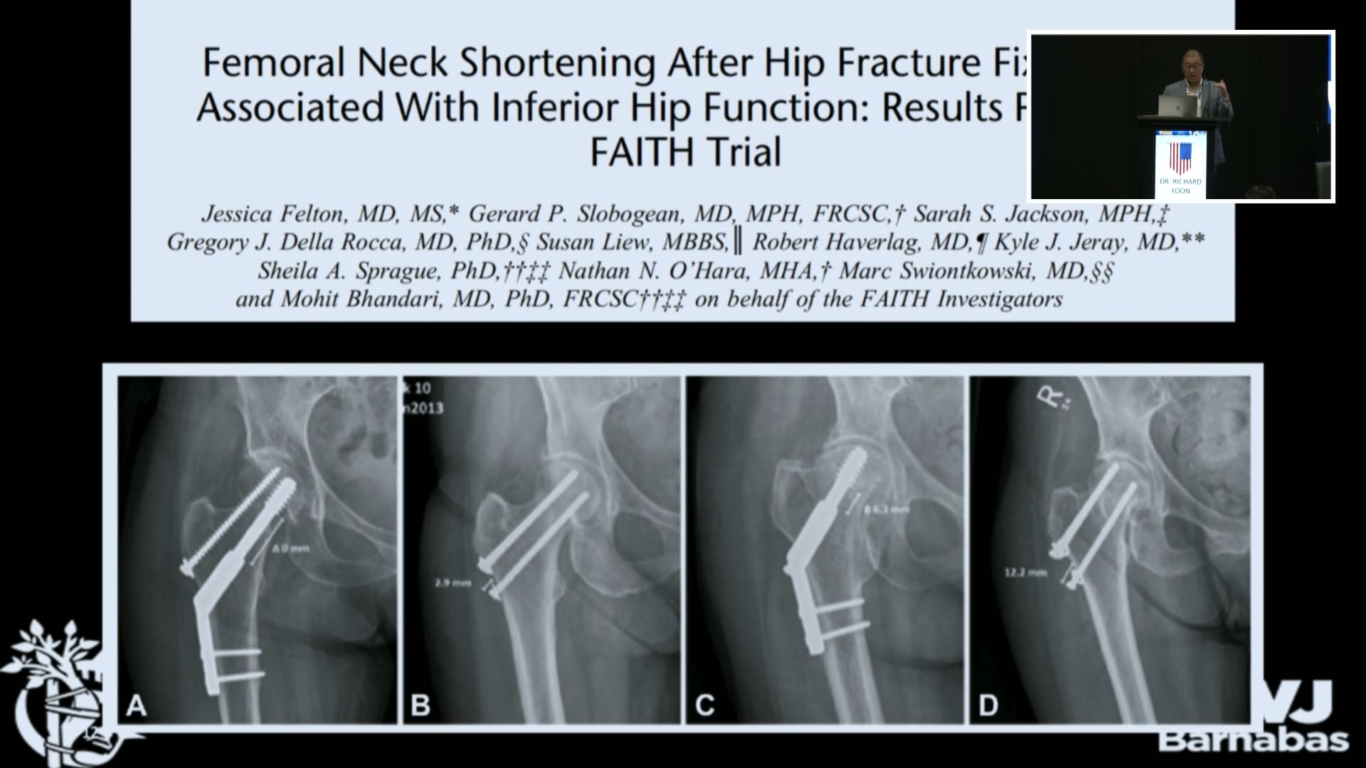 Fractura segmentaria de cuello femoral