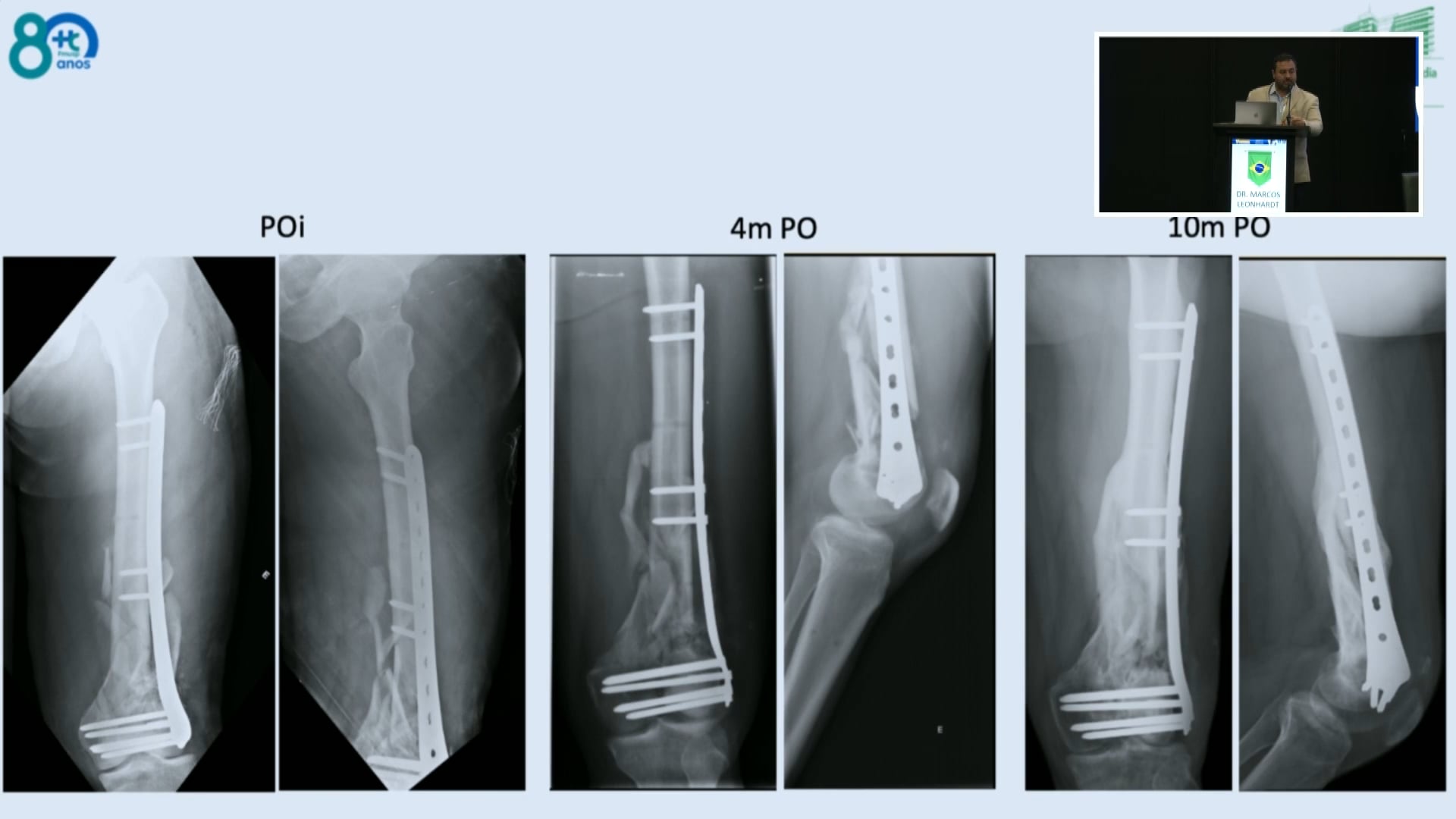 Fracturas de femur distal, estrategias para mejorar resultados
