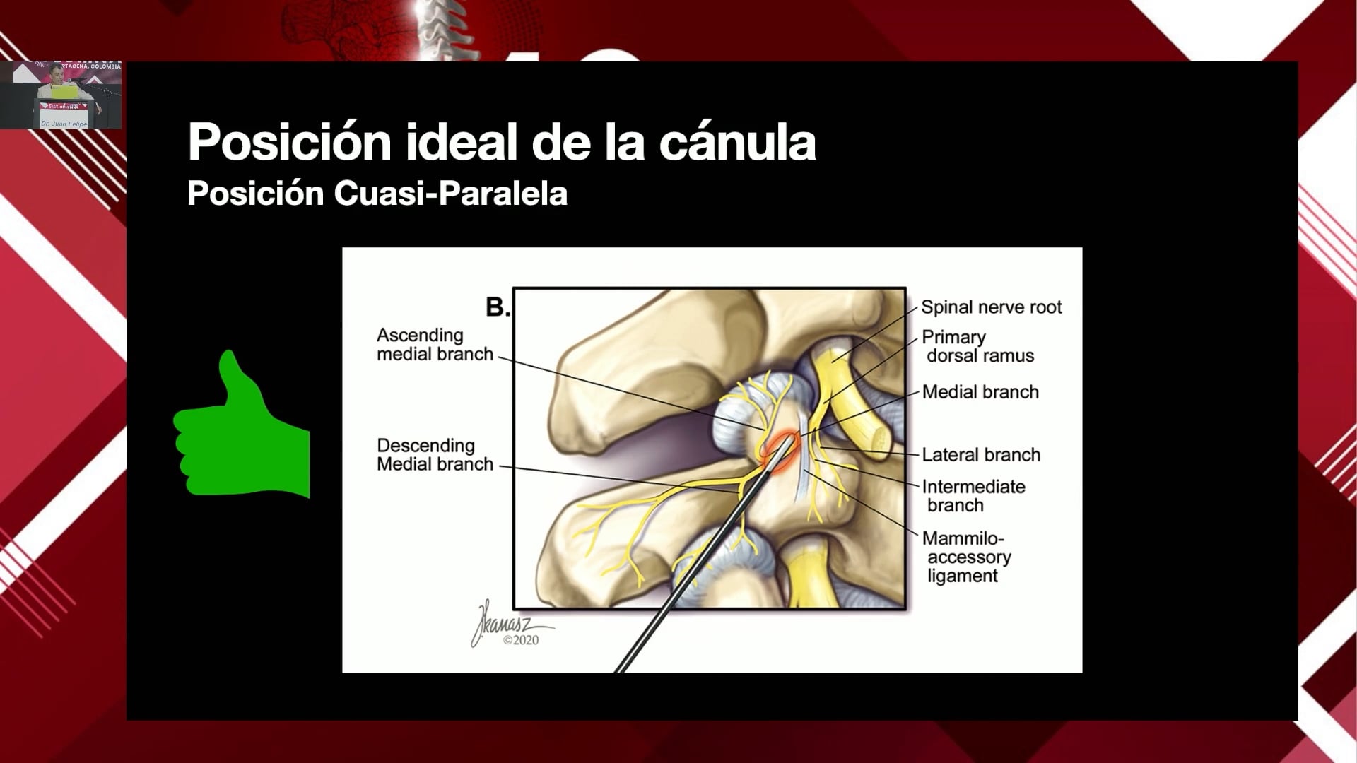 Cómo optimizar la denervación de las facetas lumbares