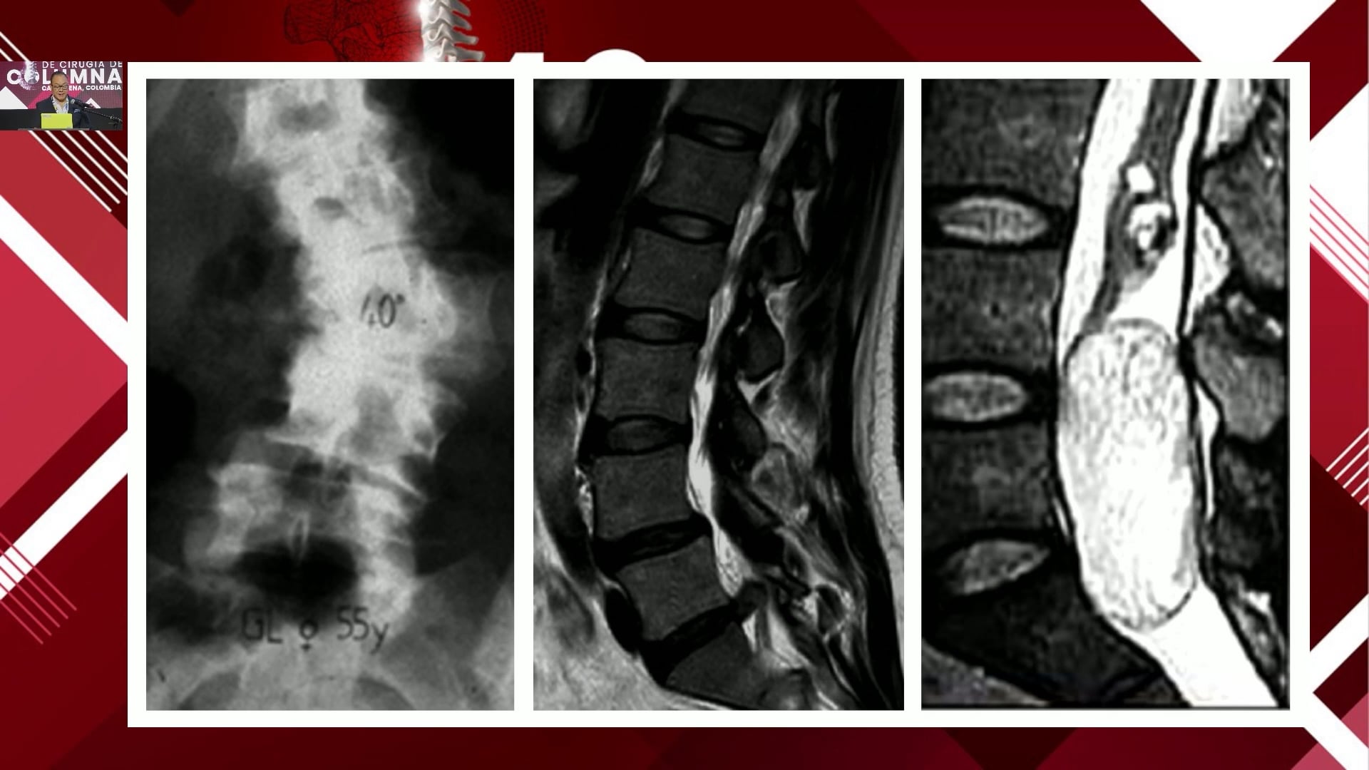 Curvas de aprendizaje en cirugía mínimamente invasiva de columna vertebral