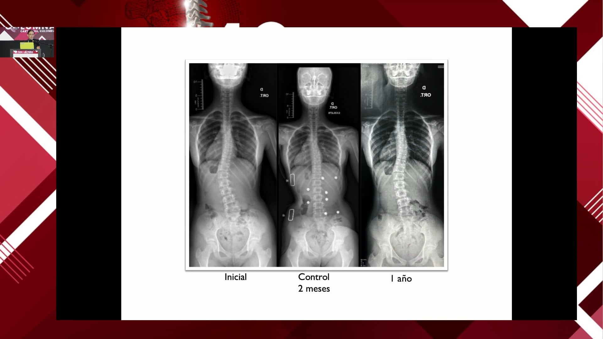 Manejo fisioterapeutico y métodos ciéntificos en escoliosis