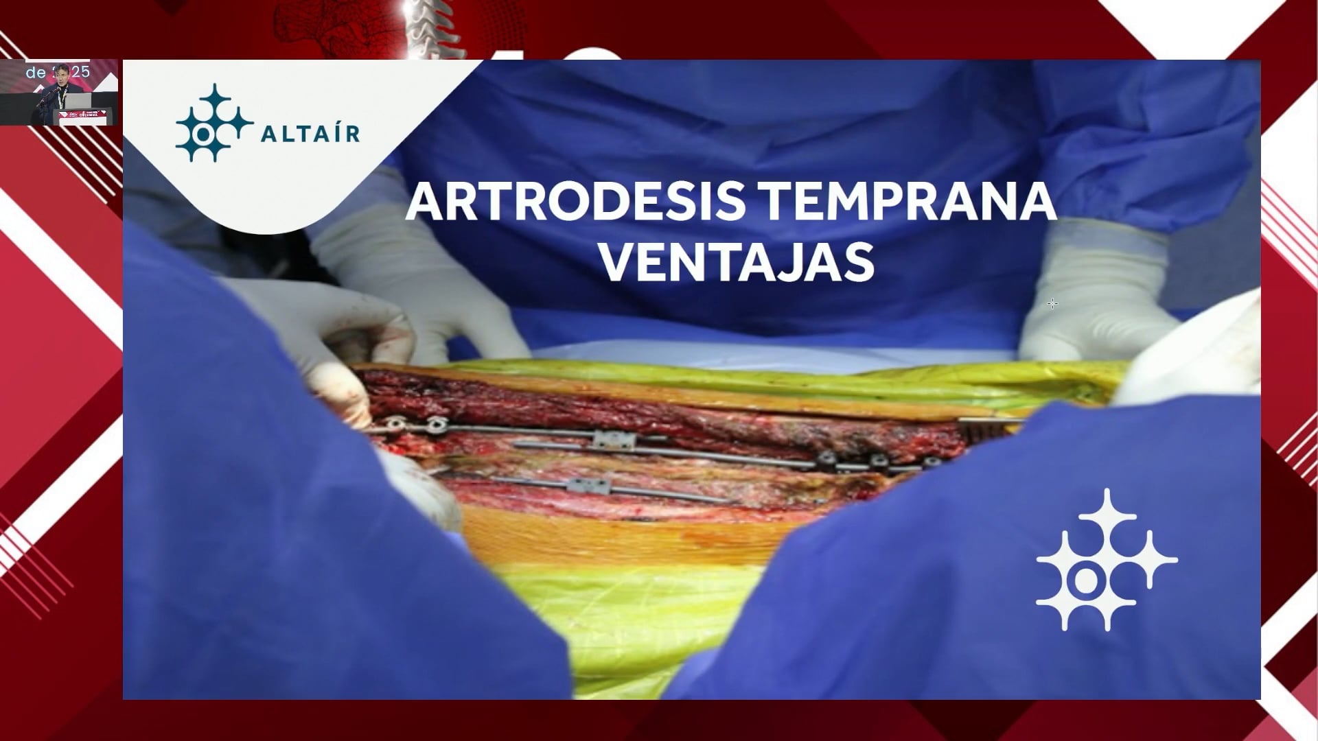 Escoliosis de inicio temprano generalidades