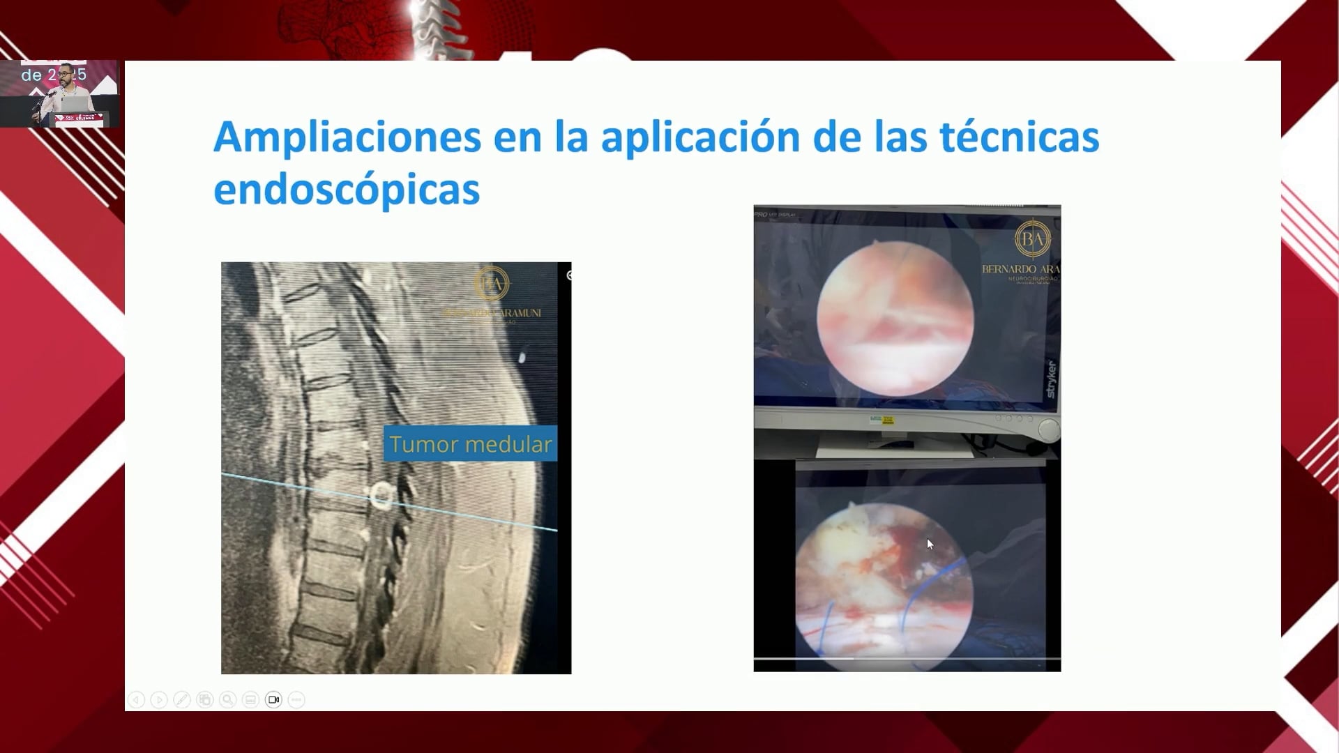 Nuevos horizontes en la cirugía endoscópica Expandiendo los límites y las indicaciones